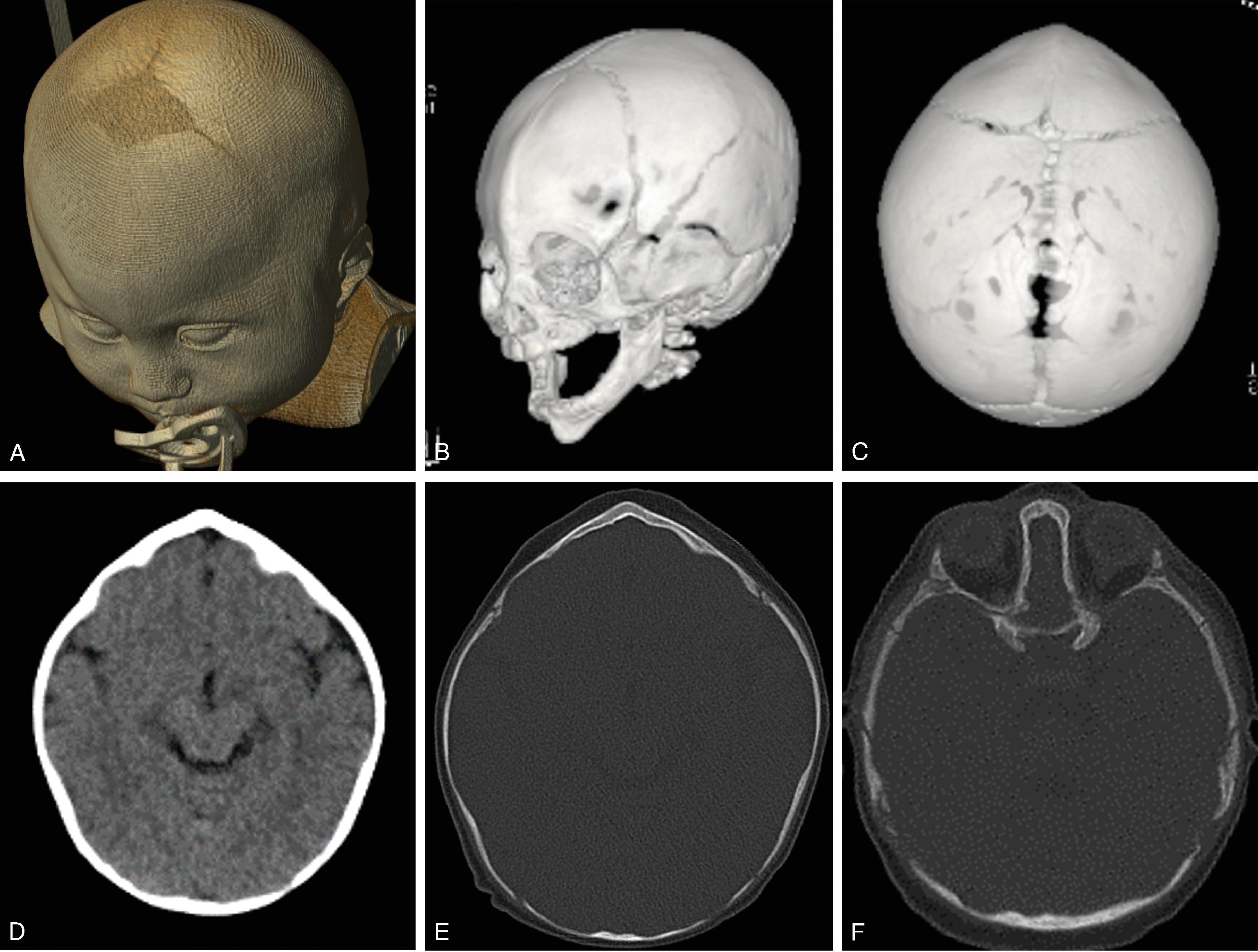 Fig. 12.2, Metopic Craniosynostosis . (A to F) 3D volumetric CT and axial CT images demonstrating metopic craniosynostosis characterized by early closure of the metopic suture and trigonocephaly of the frontal bone as well as potential for crowding of the frontal lobes and hypotelorism.