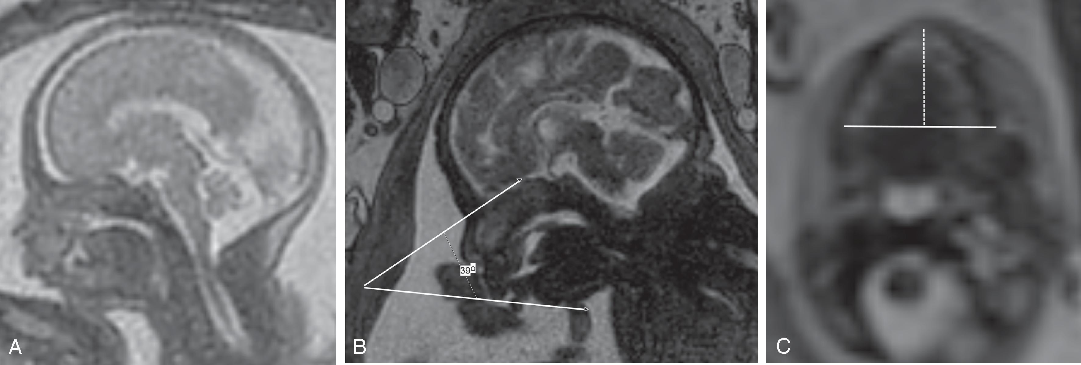 Fig. 12.27, Pyriform Aperture Stenosis . Axial CT image demonstrates narrow bilateral pyriform apertures.