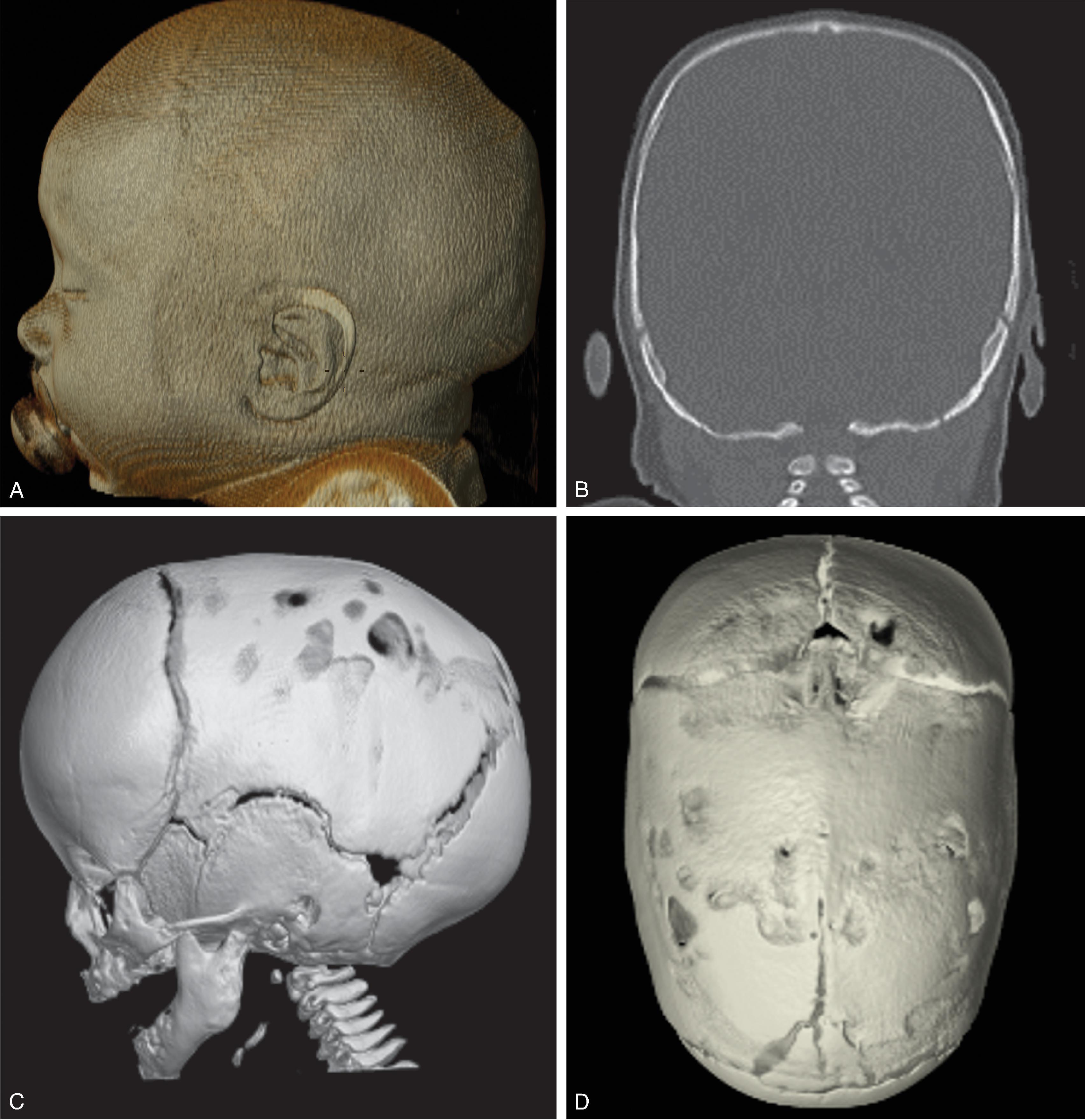 Fig. 12.3, Sagittal Craniosynostosis . (A to D) 3D volumetric CT images and coronal CT images demonstrating sagittal craniosynostosis with associated elongation of the calvarium called scaphocephaly.