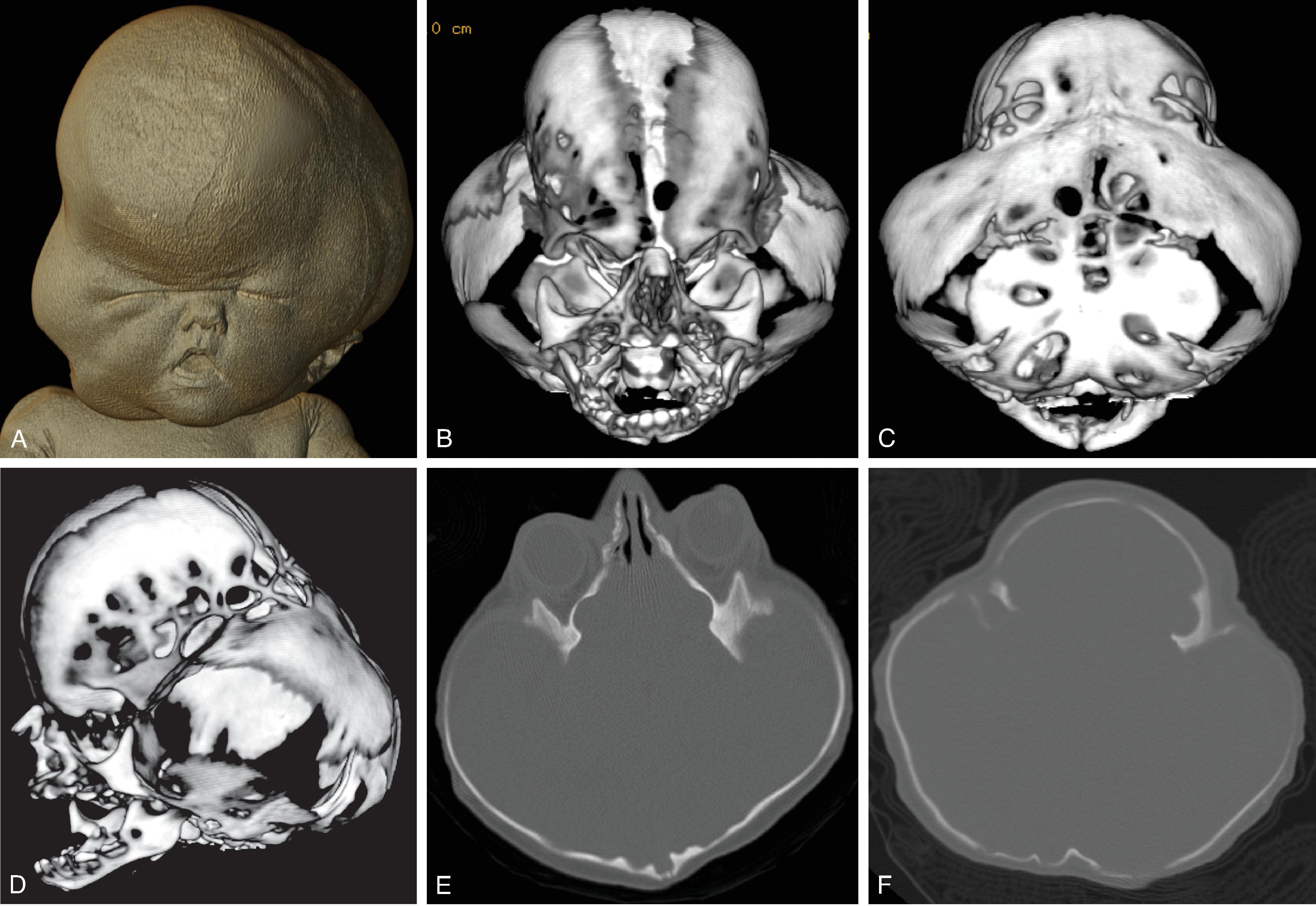 Fig. 12.15, Micrognathia . (A) Sagittal T2W image of micrognathia, retrognathia, and glossoptosis in a patient with Pierre-Robin sequence. (B) Sagittal T2W fetal image in a different patient demonstrating the inferior facial angle is abnormally low measuring 39º. (C) Axial T2W fetal image demonstrating the AP diameter (dashed line) of the mandible in a patient with micrognathia.