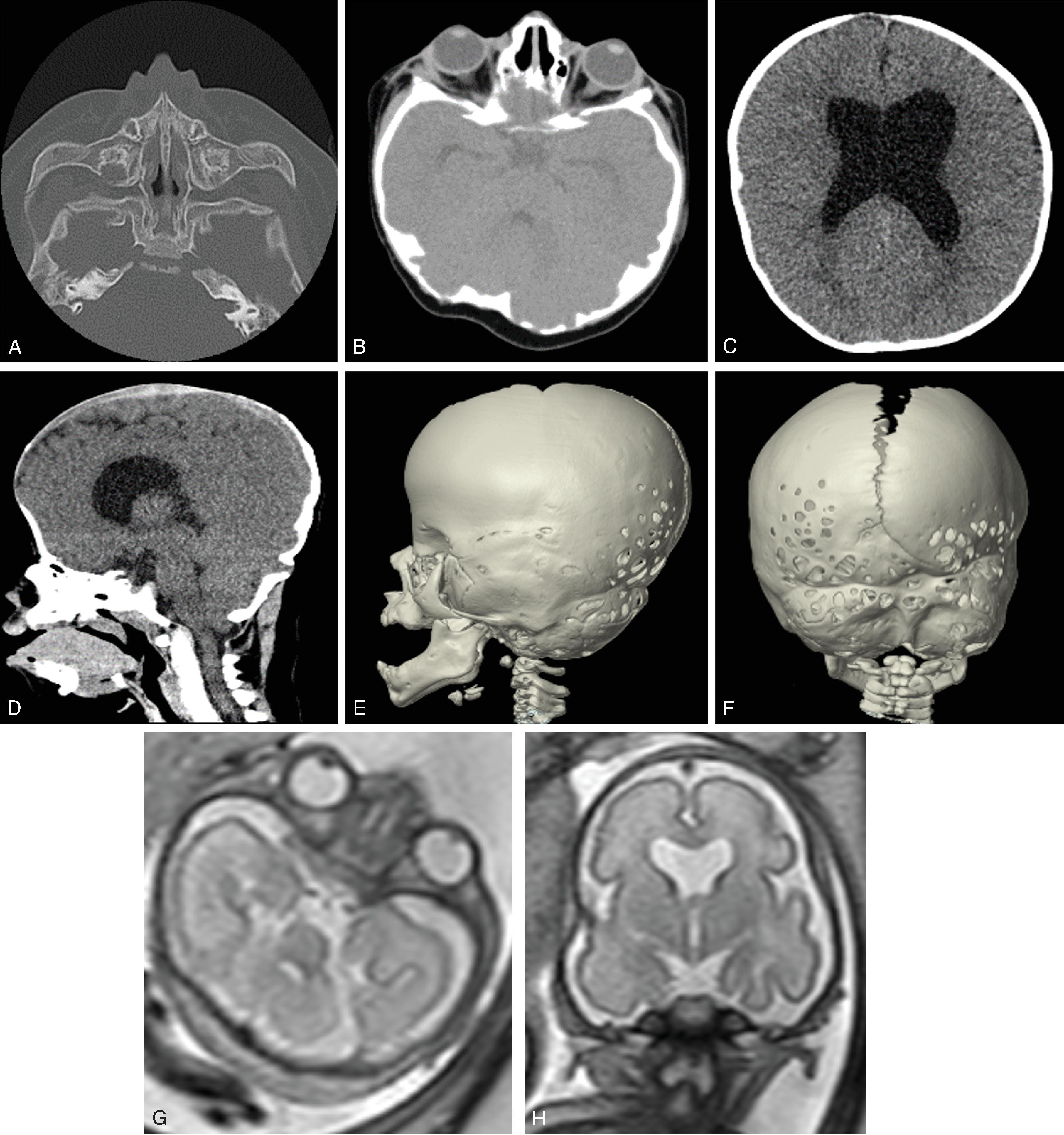 Fig. 12.7, Apert Syndrome . (A and B) 3D volumetric CT images demonstrate bilateral coronal craniosynostosis and brachycephaly. (C and D) AP hand radiographs demonstrate bilateral syndactyly.