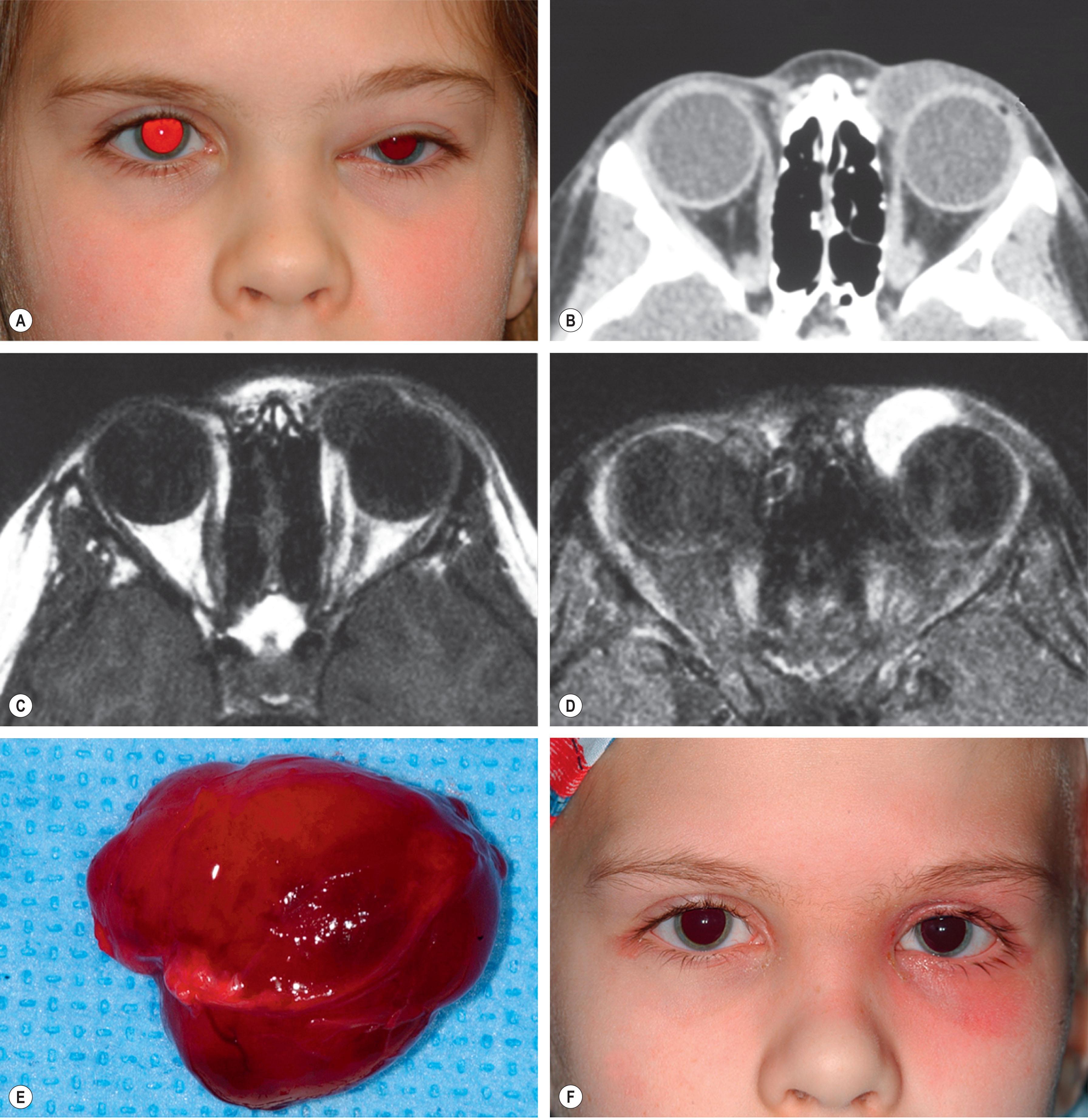 Fig. 22.1, Orbital rhabdomyosarcoma in a young girl. (A) Facial appearance showing downward displacement of left eye. (B) Computed tomography showing solid mass in orbit superonasally. (C) MRI in T1-weighted image without enhancement depicting circumscribed orbital mass. (D) MRI in T1-weighted image with gadolinium showing uniform enhancement of the malignancy. (E) Circumscribed tumor after surgical excision. (F) Slight erythema of periocular skin following radiotherapy.