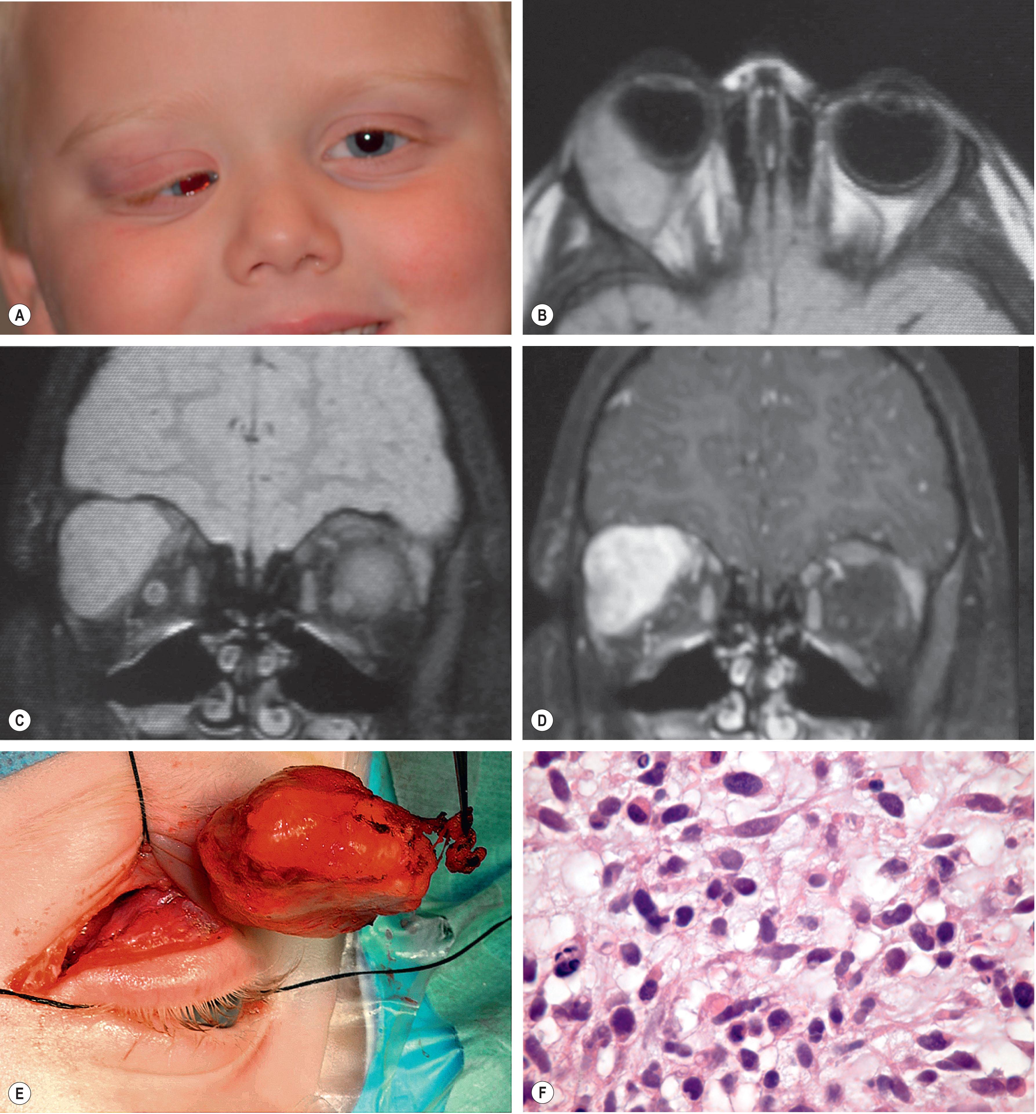 Fig. 22.2, Orbital rhabdomyosarcoma in a young boy. (A) Facial appearance showing proptosis and downward and medial displacement of right eye. (B) Axial MRI showing large superotemporal orbital mass. (C) Coronal MRI showing superotemporal mass. (D) Coronal MRI after gadolinium enhancement showing uniform enhancement of the vascular malignancy. (E) Tumor removed by superolateral orbitotomy. (F) Histopathology showing malignant elongated strap cells and round cells, consistent with orbital rhabdomyosarcoma.