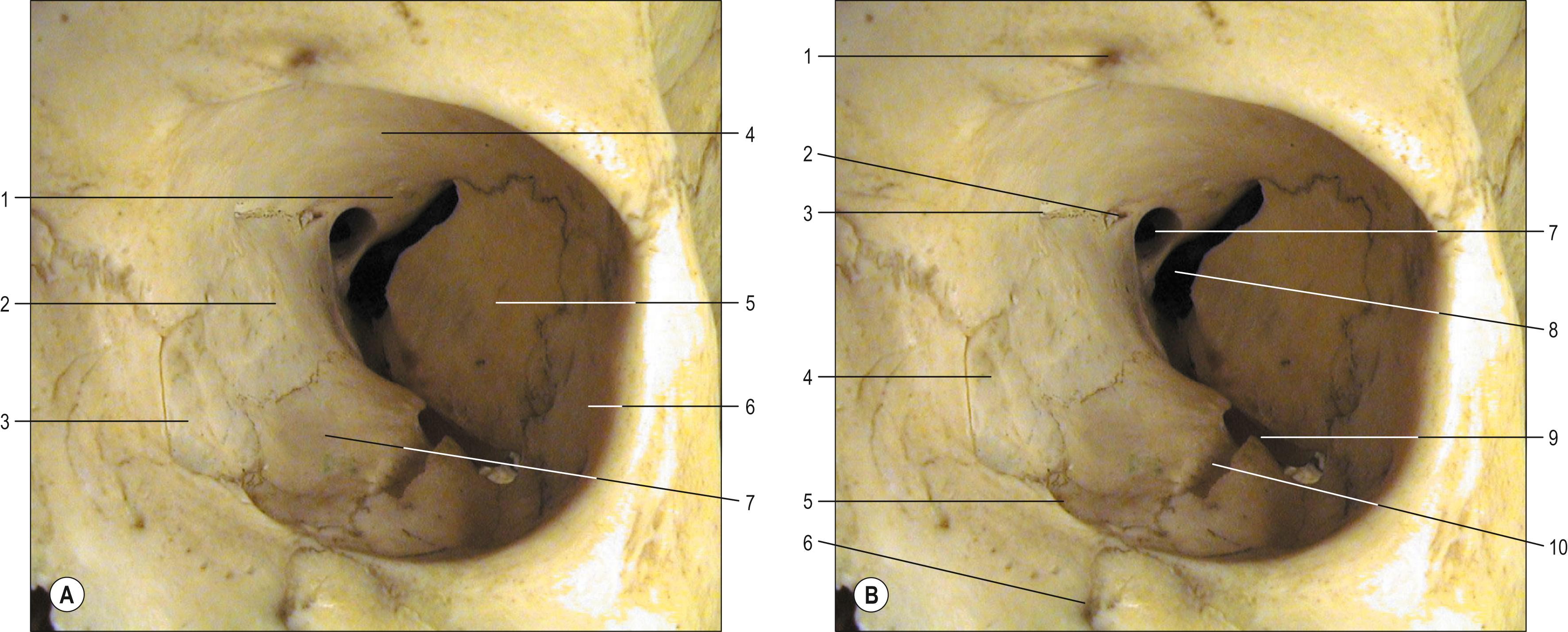 Fig. 44.2, An anterior view of the left orbit indicating the bones forming the walls ( A ) and the principal apertures ( B ). A , Key: 1, lesser wing of sphenoid; 2, orbital plate of ethmoid; 3, lacrimal bone; 4, orbital plate of frontal bone; 5, greater wing of sphenoid; 6, zygomatic; 7, orbital plate of maxilla. B , Key: 1, supraorbital foramen; 2, posterior ethmoidal foramen; 3, anterior ethmoidal foramen; 4, lacrimal fossa; 5, (canal for) nasolacrimal duct; 6, infraorbital foramen; 7, optic canal; 8, superior orbital fissure; 9, inferior orbital fissure; 10, infraorbital groove.