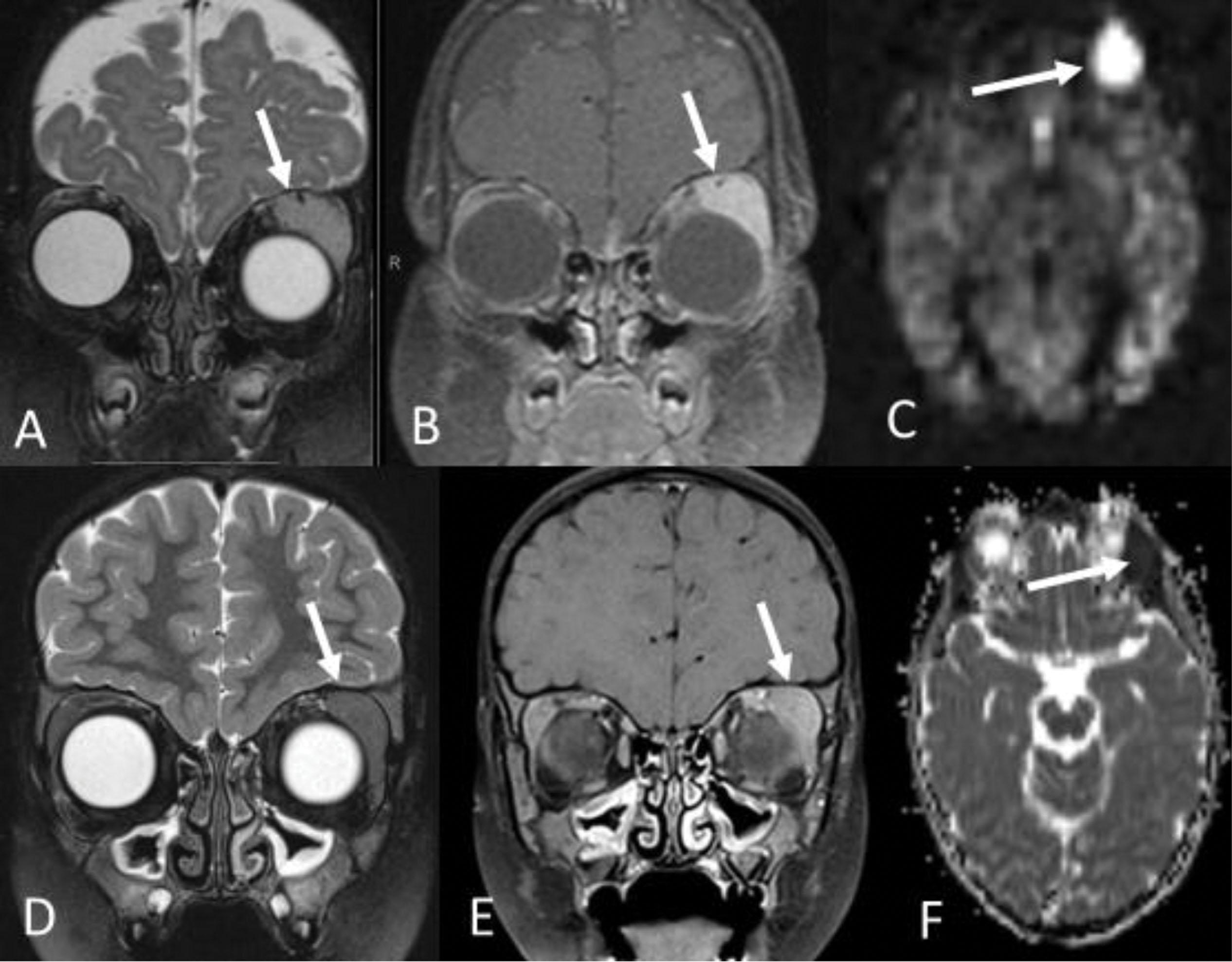 Fig. 9.1, In a 7-month-old girl with proptosis, coronal T2 (A) and T1 postcontrast (B) MRI images show a contrast-enhancing mass in the superolateral orbit displacing the globe (arrows). At this age, a leading consideration would be infantile hemangioma, and the addition of arterial spin label perfusion imaging (C) shows the marked hyperemia of the hemangioma (arrow). In contrast, a similar enhancing mass (arrows) causing proptosis in a 4-year-old girl is seen on coronal T2 (D) and T1 postcontrast (E) images, but at this age a more aggressive neoplasm is suspected. The addition of diffusion-weighted imaging with an apparent diffusion coefficient ADC map (F) shows the dark signal reflecting the reduced water diffusion of a highly cellular neoplasm (arrow), in this case chloroma from leukemia. Patient age influences imaging technique and interpretation. 2