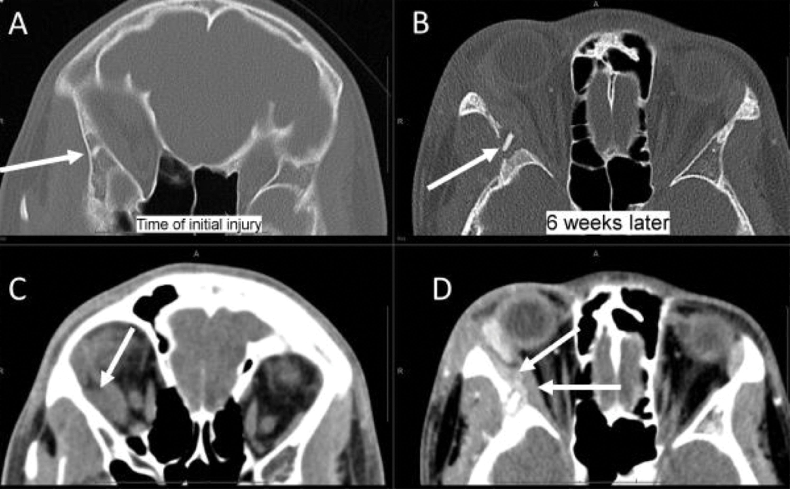 Fig. 9.2, In a 13-year-old boy with acute eye pain, contrast-enhanced axial CT (D) shows post septal inflammation adjacent to the displaced lateral rectus muscle (arrows), concerning for orbital cellulitis. There was also a hyperdense (bright on CT) structure (arrow in B) in the lateral orbital wall with surrounding osseous erosive change (B). With no known history, diagnostic considerations might have to include a bony sequestrum from infectious osteomyelitis or even a hyperdense nidus of an osteoid osteoma in an unusual location. However, this patient was stabbed by his brother with a pencil 6 weeks earlier. At that time, a non contrast CT had been performed (A and C) for “trauma” before anyone admitted to the pencil incident, only orbital hemorrhage was reported (arrow in C), and the hyperdense structure was missed (arrow in A). After the patient gave a more complete history, the second CT scan led to surgery where a small piece of graphite from the pencil was removed from the orbital wall. Clinical history can be crucial to image interpretation. 3 4