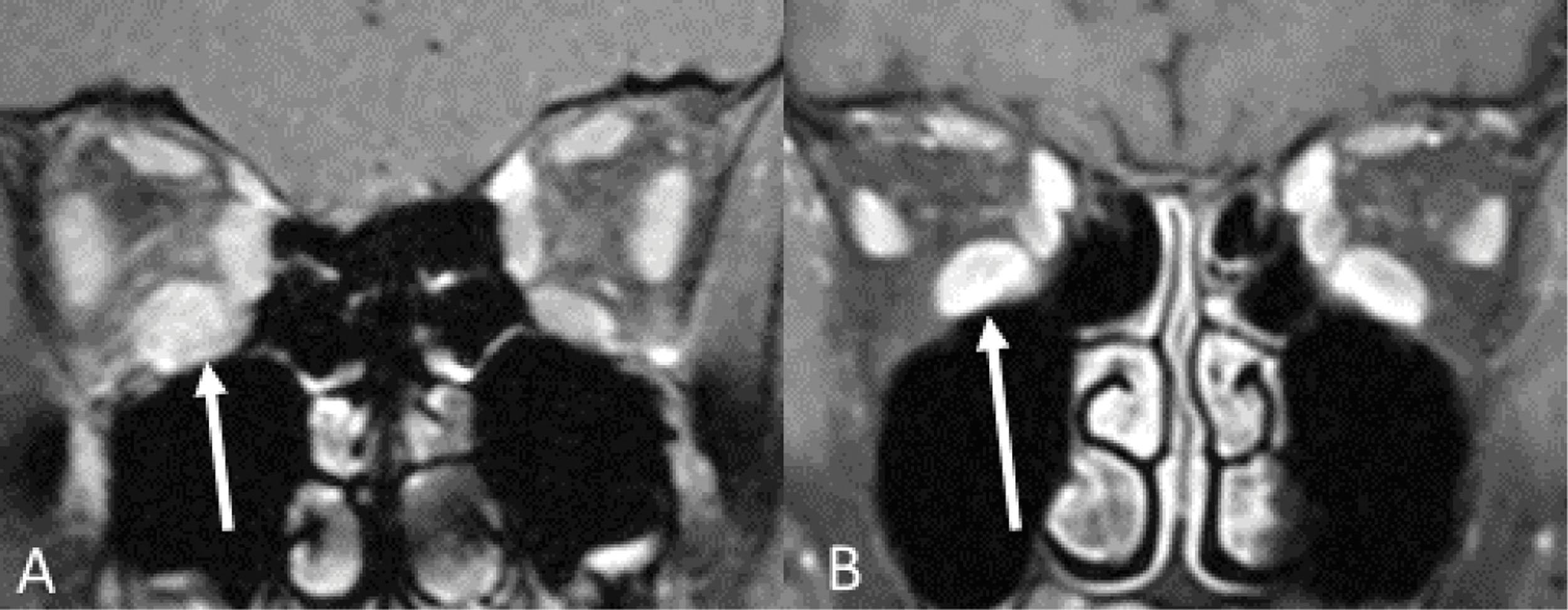 Fig. 9.3, When a 13-year-old girl presented with acute diplopia and eye pain, coronal T1 postcontrast MRI (A) showed thickening of extraocular muscles (arrow). She responded to steroids, had a recurrent episode 18 months later, and responded to steroid treatment again. The diagnosis was myositis in idiopathic orbital inflammatory syndrome. Although the coronal T1 postcontrast image of a second patient (B) has similar extraocular muscle thickening (arrow), in this second patient the past medical history of Graves disease led to a diagnosis of thyroid ophthalmopathy. Medical history can lead to different image interpretation even when imaging appearance between cases is similar. 5