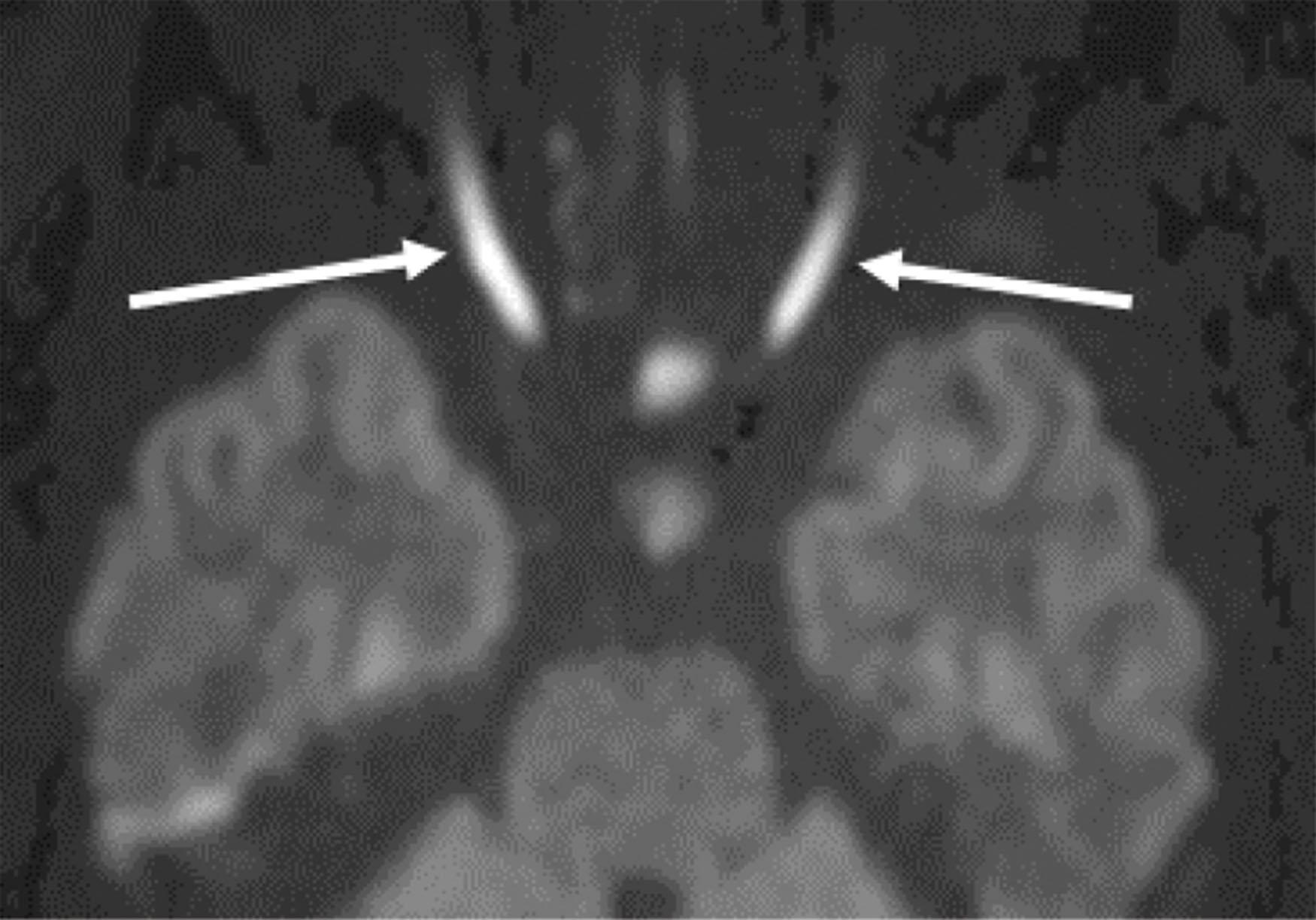 Fig. 9.4, This patient undergoing surgical resection of a meningioma at the craniocervical junction woke from anesthesia with bilateral total loss of vision (NLP). An emergency MRI of the brain and orbits was obtained. Axial diffusion-weighted imaging showed striking diffusion restriction with hyperintense signal (arrows) in both optic nerves, consistent with acute posterior ischemic optic neuropathy, a rare and poorly understood but recognized complication of some spine surgeries, particularly when performed with a prone or head down patient position, possibly due to venous stasis and ischemia. 6