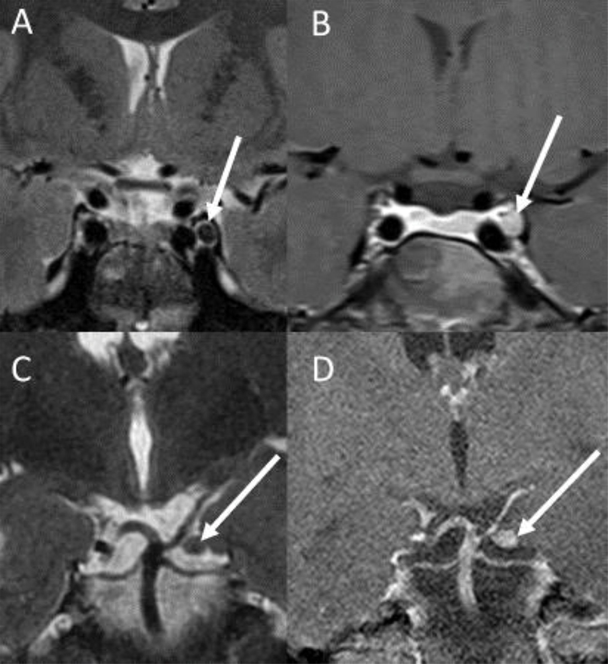 Fig. 9.6, When a 9-year-old boy presented with a “droopy eyelid” of 2 years’ duration, he was found to have an oculomotor nerve palsy. Coronal T2 (A) and T1 post contrast (B) MRI images show an enhancing sub cm nodule (arrows) in the oculomotor nerve as it enters the cavernous sinus, which was unchanged a year later, concerning for a schwannoma given its appearance and stability despite the rarity of schwannomas in children without neurofibromatosis type 2. Although the imaging appearance of the cisternal segment of the left oculomotor nerve is similar in a different patient (C and D), the episodic transient nature of imaging findings on follow-up studies and this patient’s periodic transient headaches with left ocular pain and diplopia led to a diagnosis of ophthalmoplegic migraine. 8 The temporal pattern of the clinical findings is crucial to image interpretation.