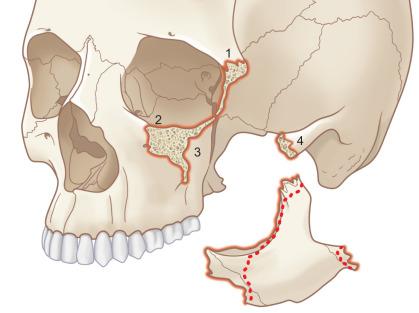 Fig. 1.12.1, Disarticulated zygoma showing attachment sites with the frontal, maxillary, and temporal bones.