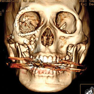 Fig. 1.12.4, Three-dimensional reconstruction showing postoperative results following open reduction and internal fixation.