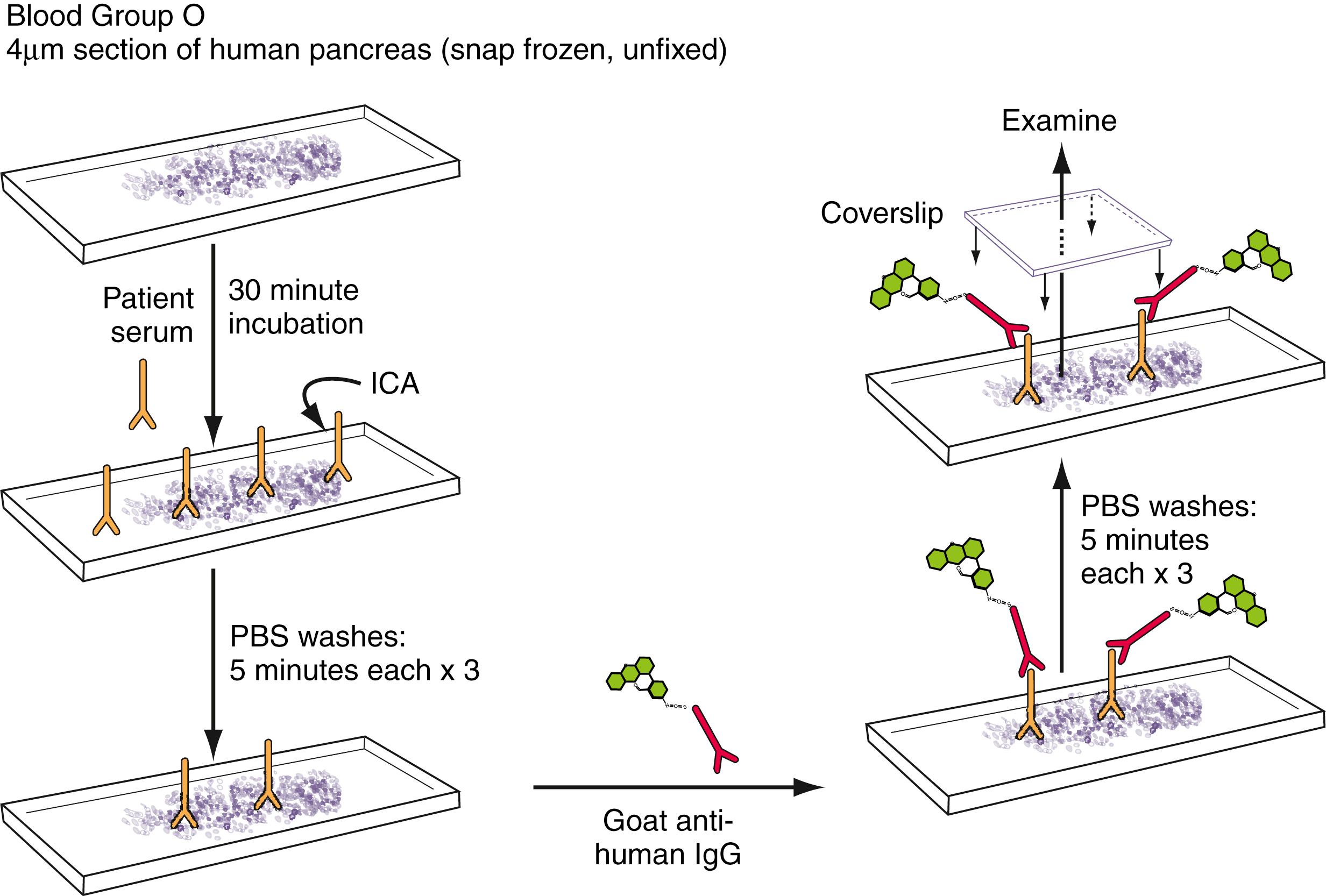 Fig. 55.3, Islet cell cytoplasmic autoantibody (ICA) testing is performed by indirect immunofluorescence. Patient serum is applied to a cryo-cut section of snap-frozen human blood group O pancreas. After incubation and washing, FITC (fluorescein-isothiocyanate)-labeled goat-antihuman IgG is applied. After washing and the application of glycerol and a coverslip, the slide is examined using an epifluorescence microscope. If the islets fluoresce, the patient’s serum contains ICA that binds to islet autoantigens in the tissue that were detected by the FITC-labeled goat-antihuman IgG. PBS, phosphate-buffered saline.