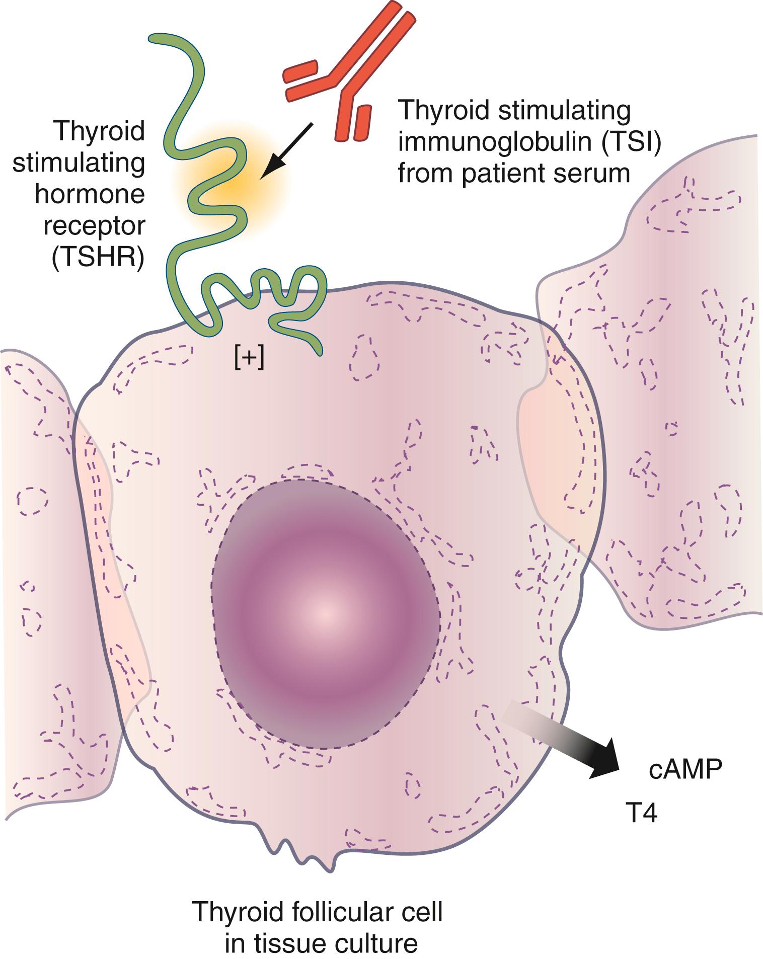 Fig. 55.4, Thyroid-stimulating immunoglobulins (TSIs) are detected by in vitro studies where patient serum is added to thyroid follicular cells. The effect of the TSI is measured by the release of cAMP or T4 from the cell.