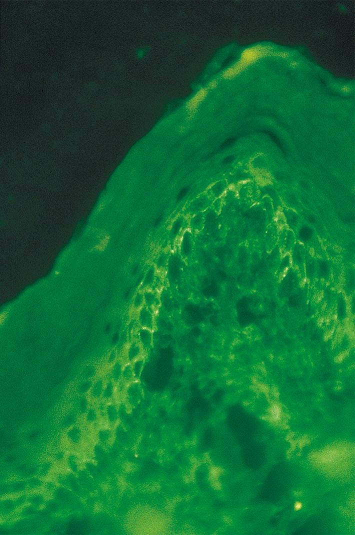 Fig. 55.5, Direct immunofluorescence microscopy of skin lesions in pemphigus shows linear/granular C3 deposition on the cell surfaces (intercellular spaces) of mainly basal keratinocytes without basement membrane zone (BMZ) immunofluorescence (×400).