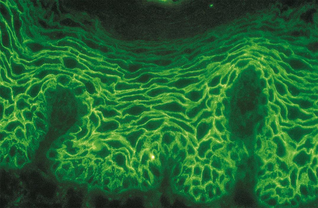 Fig. 55.6, Indirect immunofluorescence microscopy in pemphigus shows linear immunoglobulin (IgG) immunofluorescence on the cell surfaces of epithelial cells (intercellular spaces) using mouse esophagus as tissue substrate (×250).