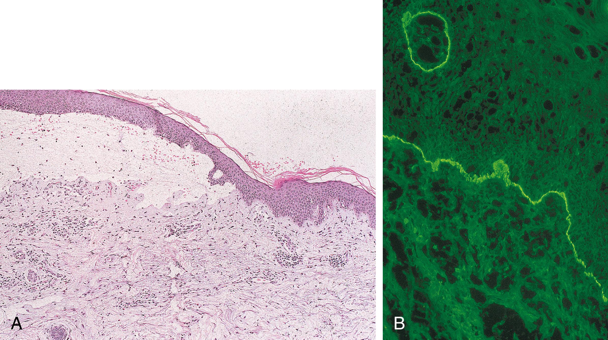 Fig. 55.7, A Skin biopsy of pemphigoid reveals a subepidermal split, nonnecrotic epidermis, and variable inflammation, often with prominent eosinophils (H&E, ×100). B Direct immunofluorescence microscopy reveals intense linear C3 deposition along the basement membrane zone (BMZ) (×400).