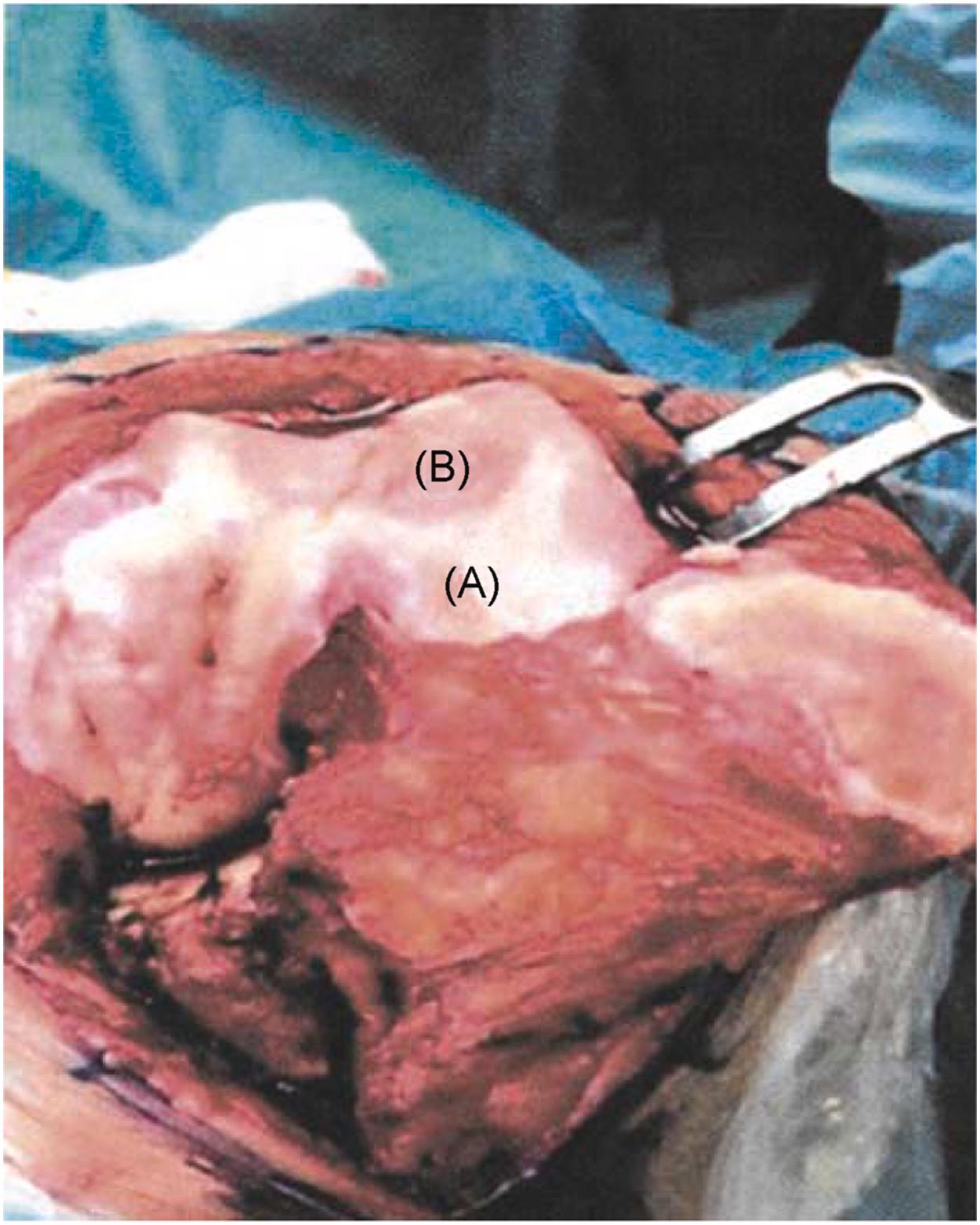 Figure 1.1, Macroscopic signs of osteoarthritis knee hyaline cartilage: (A) healthy cartilage and (B) osteoarthritis cartilage.