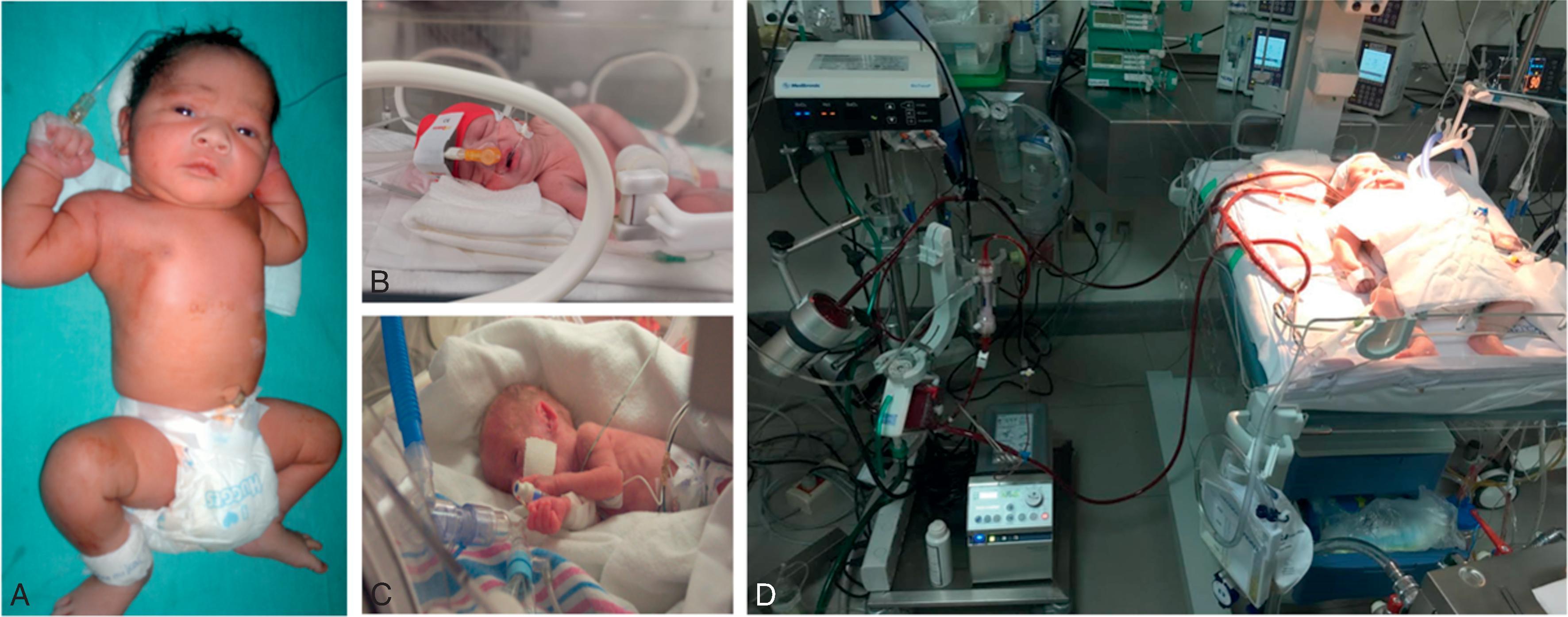 Fig. 100.1, (A) Term infant in a level I nursery (sick newborn care unit) in India recovering from transient tachypnea. (B) A 34 weeks’ gestation premature infant with mild respiratory distress syndrome (RDS) receiving continuous positive airway pressure support in a level II neonatal intensive care unit (NICU) in Iraq. (C) A 27 weeks’ gestation premature infant with moderately severe RDS on assisted ventilation in a level III NICU in the United States. (D) A term infant with a congenital cardiac defect being supported with extracorporeal membrane oxygenation in a level IV NICU in Uruguay.