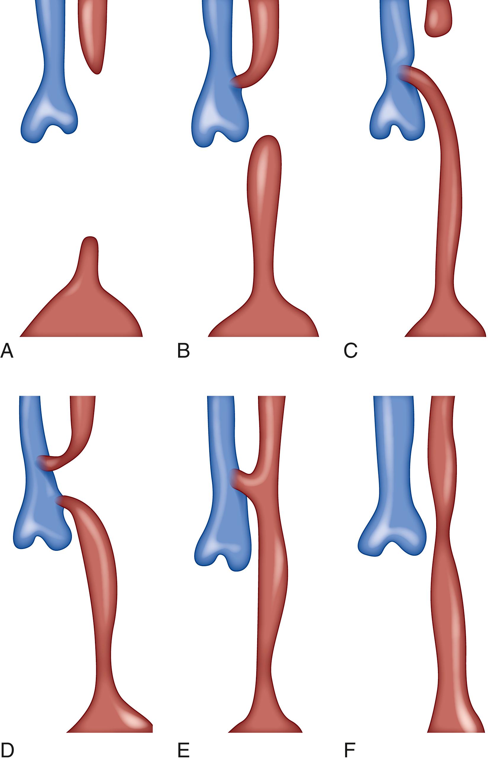 Fig. 82.2, Types of esophageal atresia and tracheoesophageal fistula. The tracheal pouch and the lower and upper esophageal pouches are represented in blue and pink, respectively. (A) Type A, isolated esophageal atresia. (B) Type B, blind-ending lower esophageal pouch with a fistula between the trachea and the upper esophageal pouch. (C) Type C, esophageal atresia with a blind proximal esophageal pouch and a distal tracheoesophageal fistula. This anomaly represents approximately 85% of all esophageal atresia. (D) Type D, esophageal atresia with two fistulas between the trachea and the lower and upper esophageal pouches. (E) Type E, fistula between the esophagus and the trachea. (F) Congenital esophageal stenosis.
