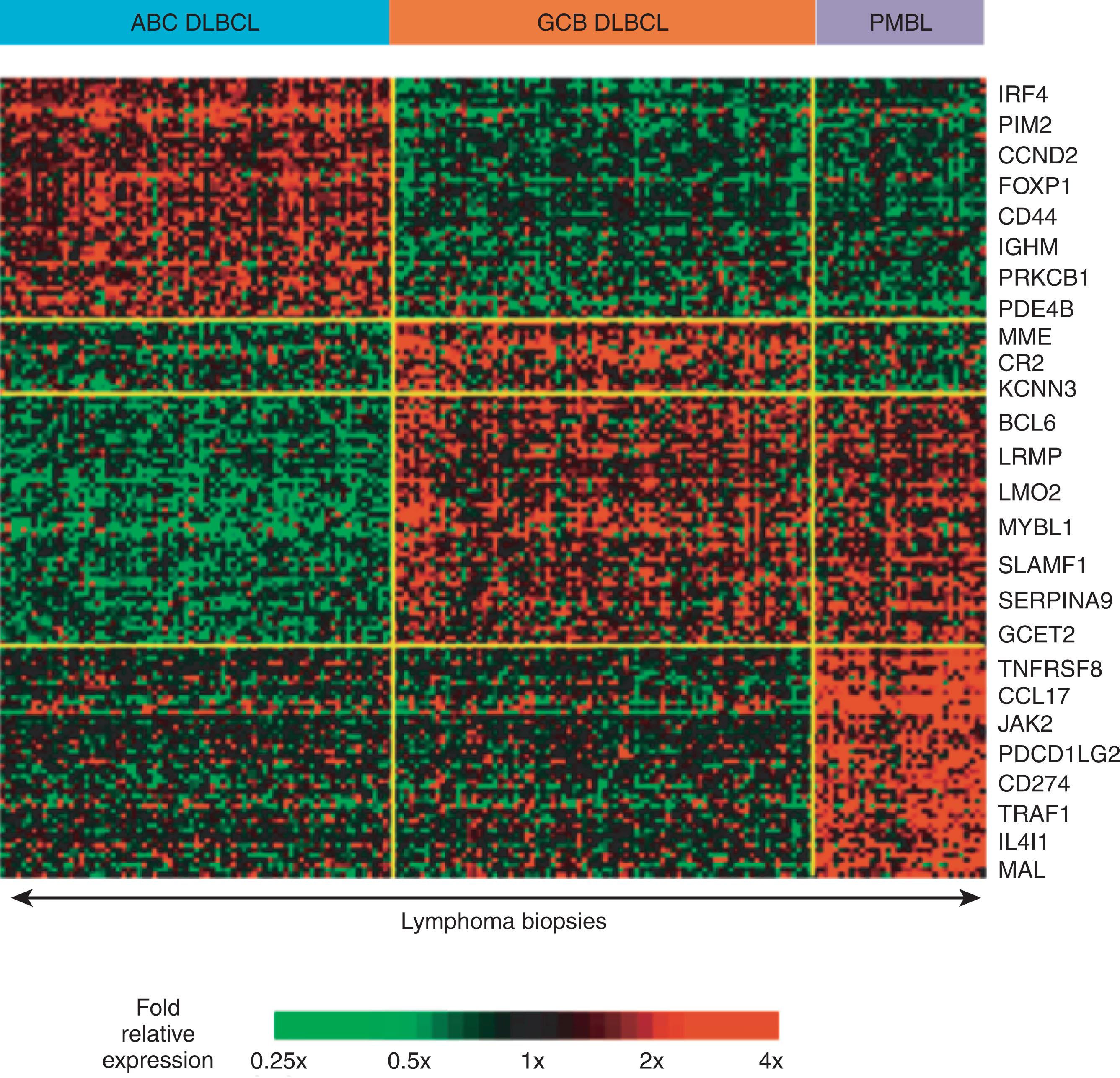 Figure 81.4, GENES CHARACTERISTICALLY EXPRESSED BY SUBGROUPS OF DIFFUSE LARGE B-CELL LYMPHOMA (DLBCL).