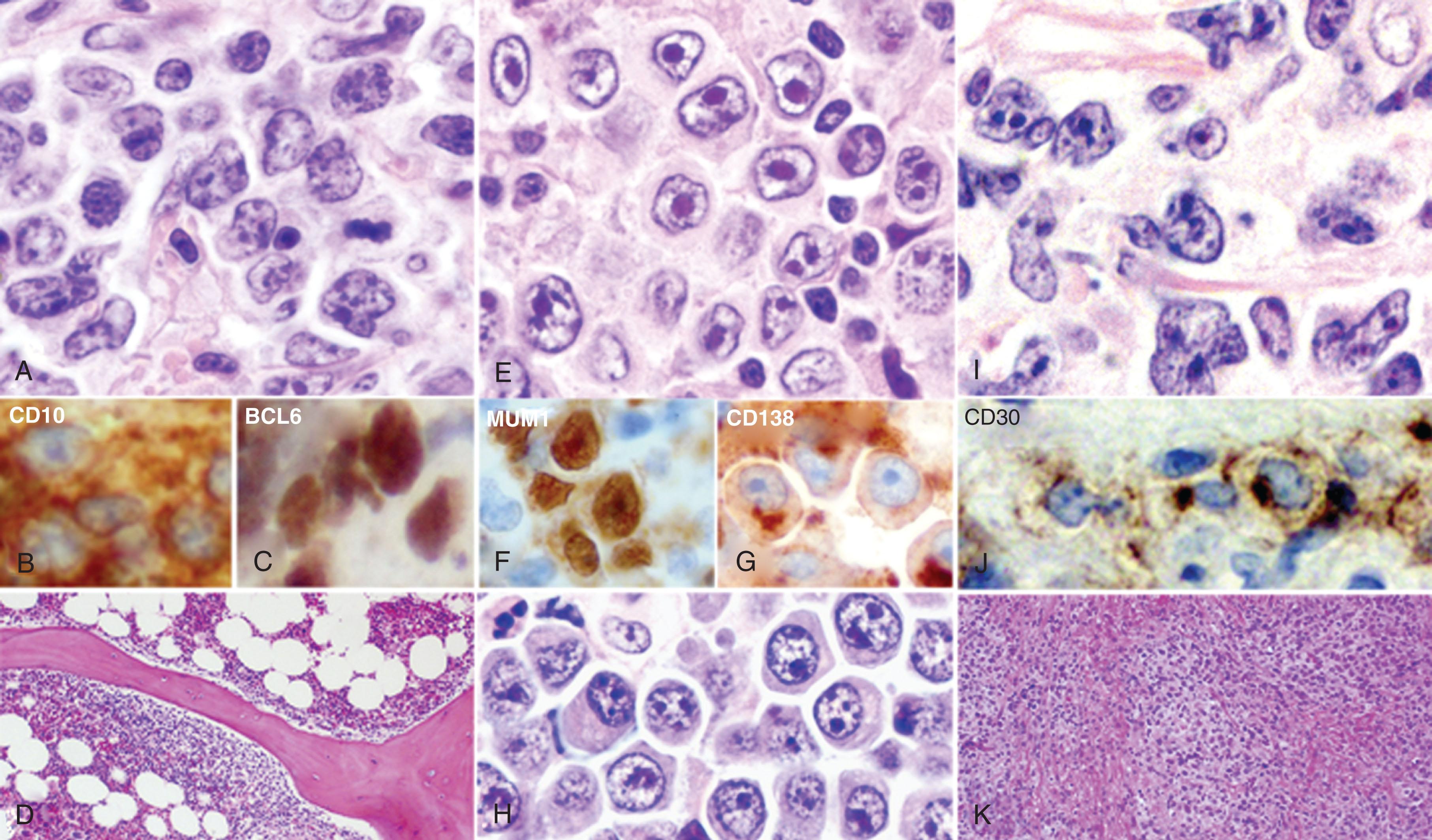 Figure 81.5, THREE TYPES OF DIFFUSE LARGE B-CELL LYMPHOMA DELINEATED BY HISTOLOGIC PATTERNS.