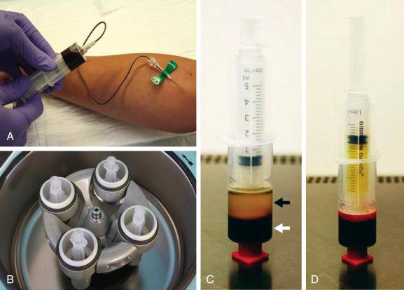 Fig. 5.2, Autologous platelet-rich plasma preparation using a single-step centrifugation system. (A) Autologous whole blood is aspirated in a double-syringe system. (B) The syringe is then placed in corresponding buckets of a desktop centrifuge and spun after balancing. (C) The serum fraction containing the clotting factors, white blood cells, and the platelets (buffy coat) (black arrow) is separated from the red blood cell fraction (white arrow) . (D) By pulling the stamp of the second syringe of the closed system, the serum fraction is extracted from the red blood cell fraction in a sterile manner for further use.