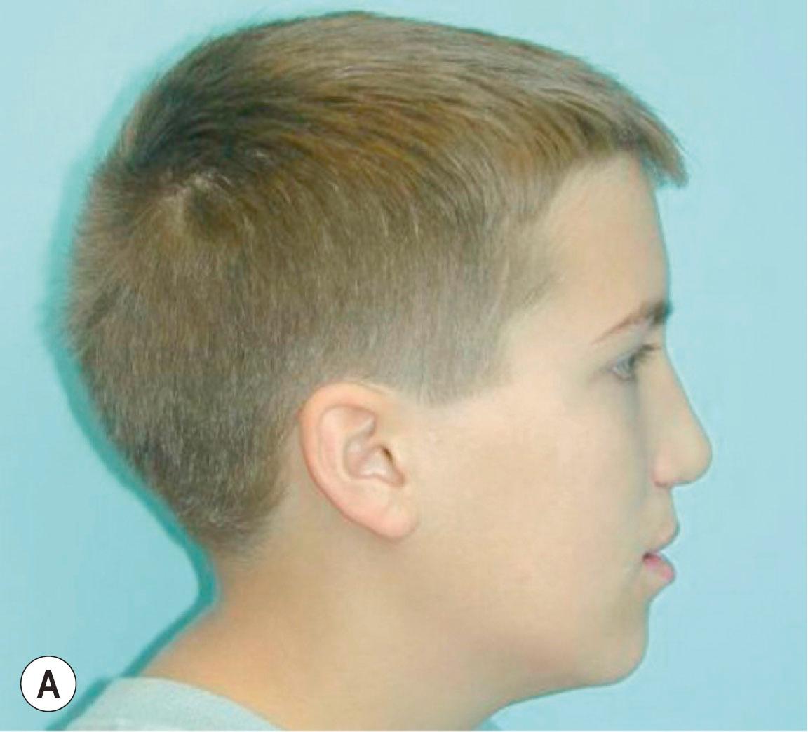 Figure 21.8.1, (A–I) Facial and (J–R) intraoral photographs; (S–U) panoramic and (V–X) lateral cephalometric radiographs of a patient with unilateral cleft lip and palate. The patient underwent lip and palate surgery in infancy. He had an alveolar bone graft in the transitional dentition. He had a diminutive tooth number 7 that was extracted and substituted with number 6. In late childhood, maxillary deficiency was noted and persisted until adolescence. He had orthodontic preparation of the dentition and underwent surgical maxillary advancement with rigid fixation. His treatment was successful, with satisfactory facial, occlusal, and skeletal outcomes.