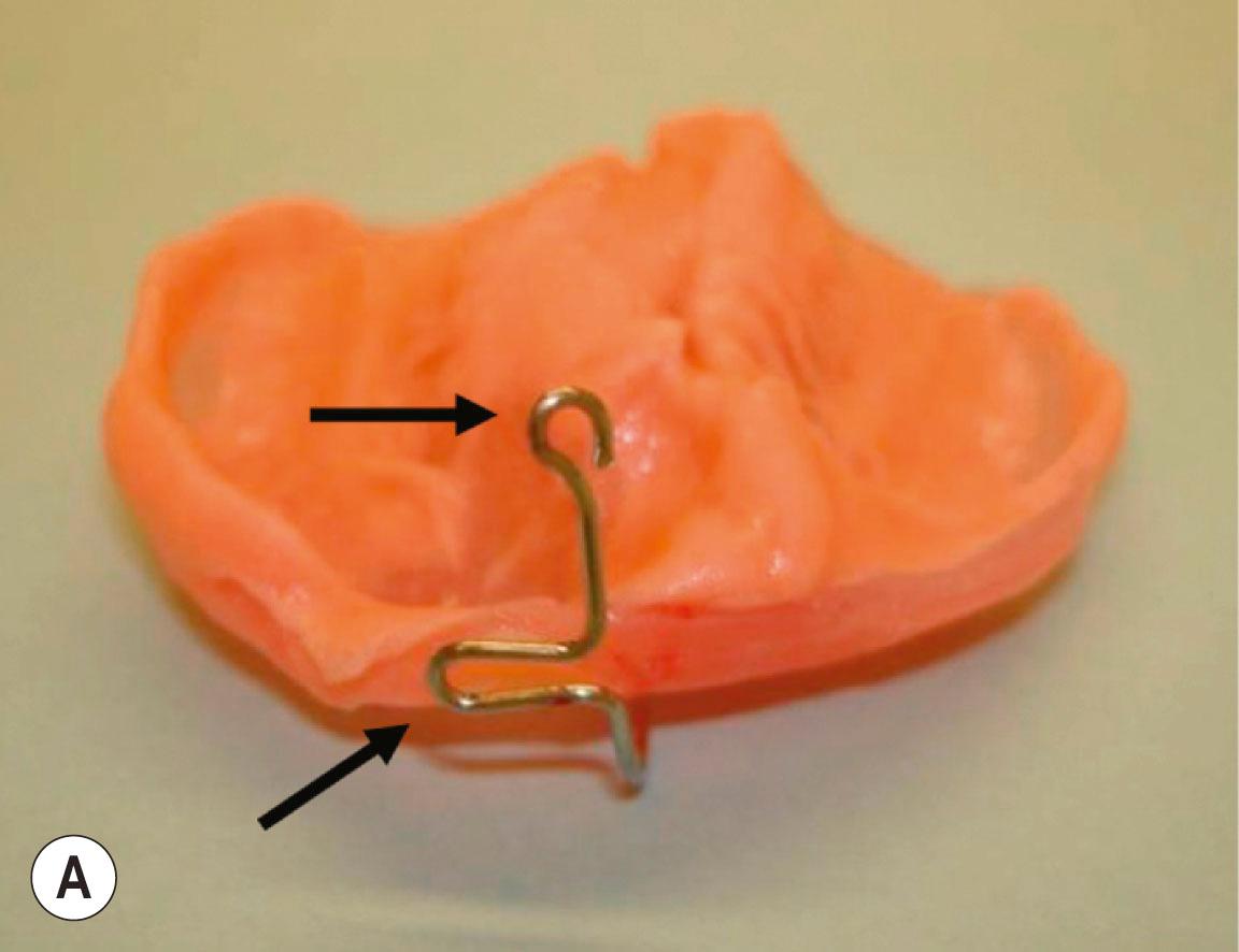 Figure 21.8.3, The wire is cut and bent, leaving an “adjustment loop” (lower arrow) and a terminal loop (upper arrow) to attach the nasal conformer part of the stent (A) . The end of the wire is covered by hard acrylic and lined with soft acrylic to fabricate the nasal conformer (arrows) (B) . Patient without (C) and with (D) nasoalveolar molding plate in place, note elevation of the cleft nostril.