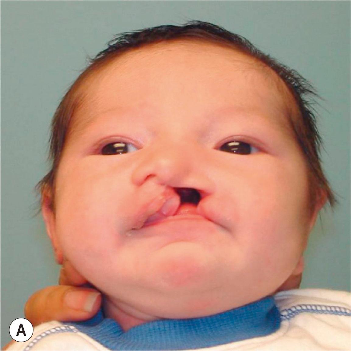 Figure 21.8.4, Facial photographs of a patient with unilateral cleft lip and palate before (A) , after nasoalveolar molding and before lip surgery, frontal view (B) and worm’s-eye view (C) . Intraoral views before (D) and after (E) nasoalveolar molding. Note alveolar and palatal cleft narrowing and improved nasal form after nasoalveolar molding and prior to lip surgery. Frontal facial photograph after nasoalveolar molding and lip surgery (F) .