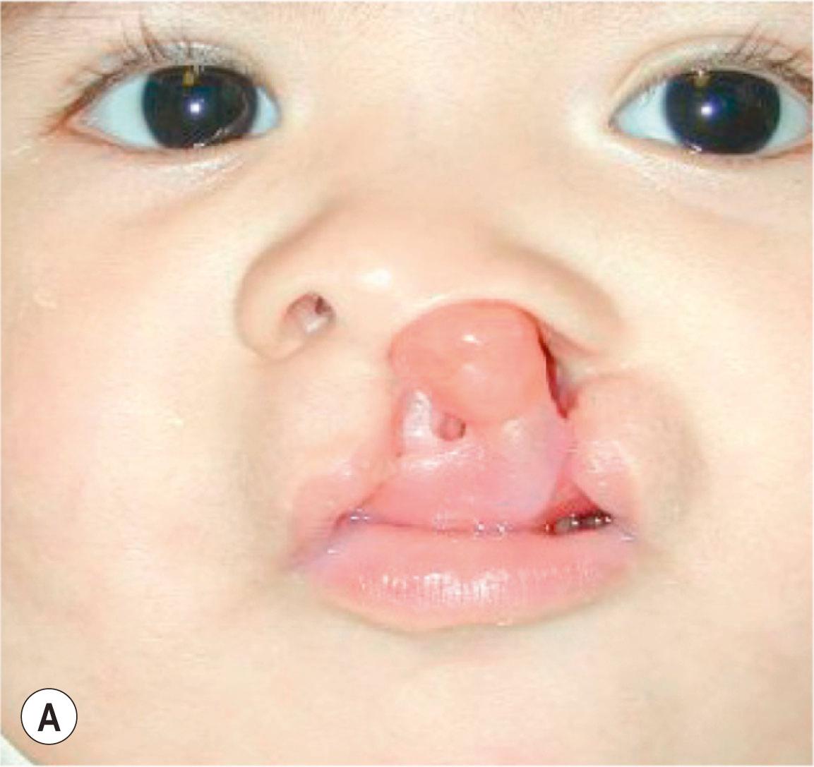 Figure 21.8.5, Patient with unilateral cleft lip and palate undergoing nasoalveolar molding (A) and with facial taping (B) . Note rounding of the alar cartilage around the nasal stent.
