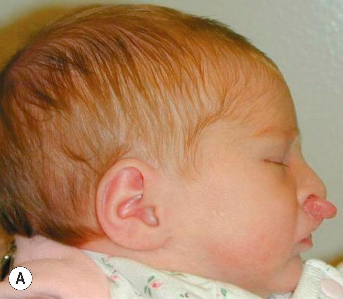 Figure 21.8.7, (A) Frontal, (B) profile, and (C) intraoral photographs of a patient with bilateral cleft lip and palate with protrusive and deviated premaxilla. She underwent premaxillary repositioning with an intraoral plate with elastomeric chain (D–F) . Frontal (G) , profile (H) , and nasal submental view (I) after premaxillary repositioning and prior to nasal molding. Note reduction of premaxillary asymmetry and protrusion as well as improved nasal form.