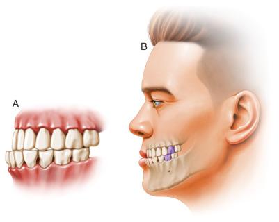 Figure 23.3, Angle classification: class III occlusion. (A) Schematic diagram of class III occlusion. (B) Diagram of class III occlusion and relation to overlying skin - soft tissue envelope.