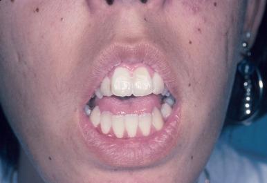 Figure 23.4, A patient with vertical maxillary excess (VME). VME is often associated with excess incisor show and gummy smile.