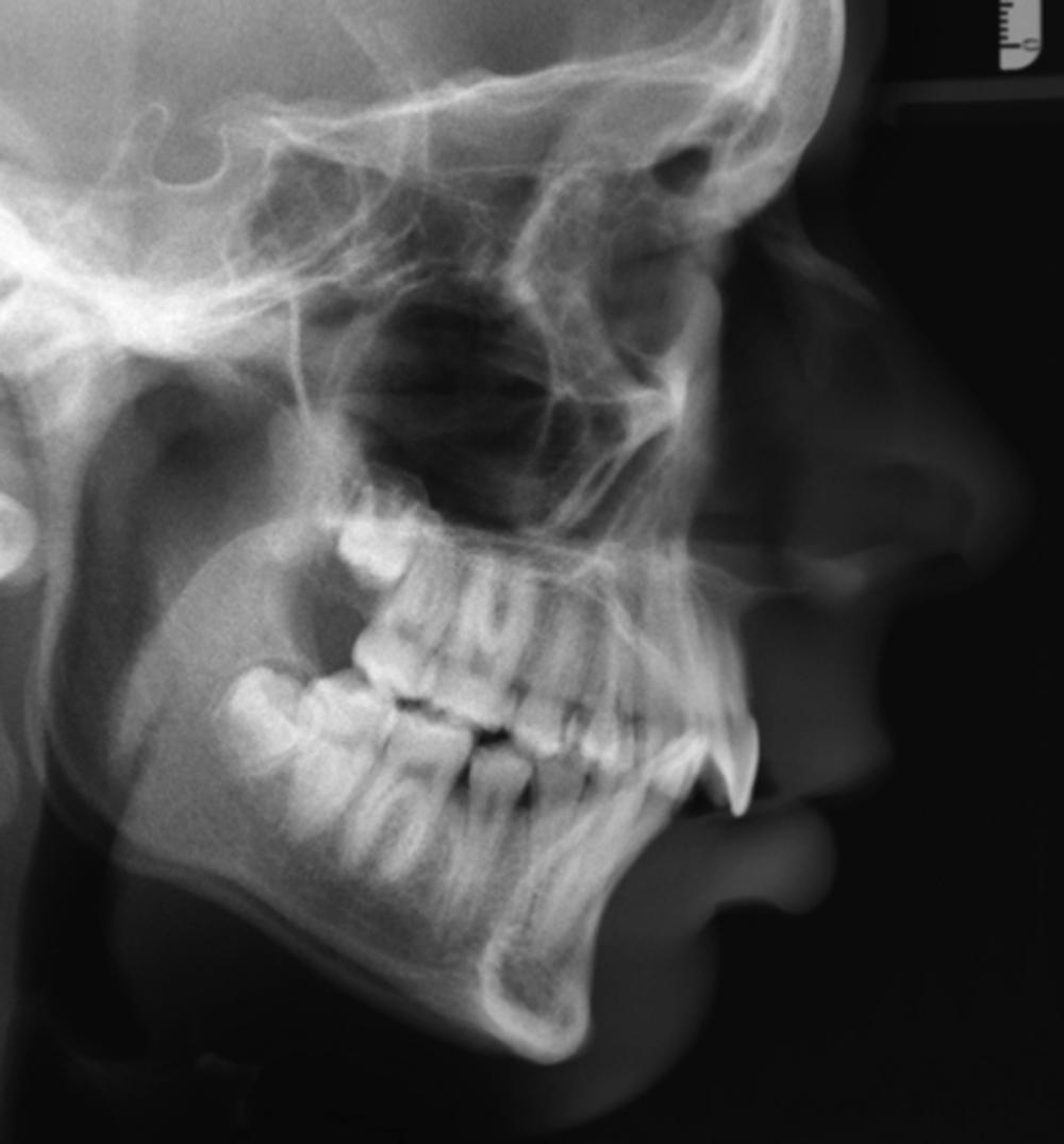 Fig. 21.11, Preoperative radiography. An example of a lateral cephalogram showing detailed craniofacial bony anatomy. The overlying soft tissue can often be identified when performing this imaging modality.