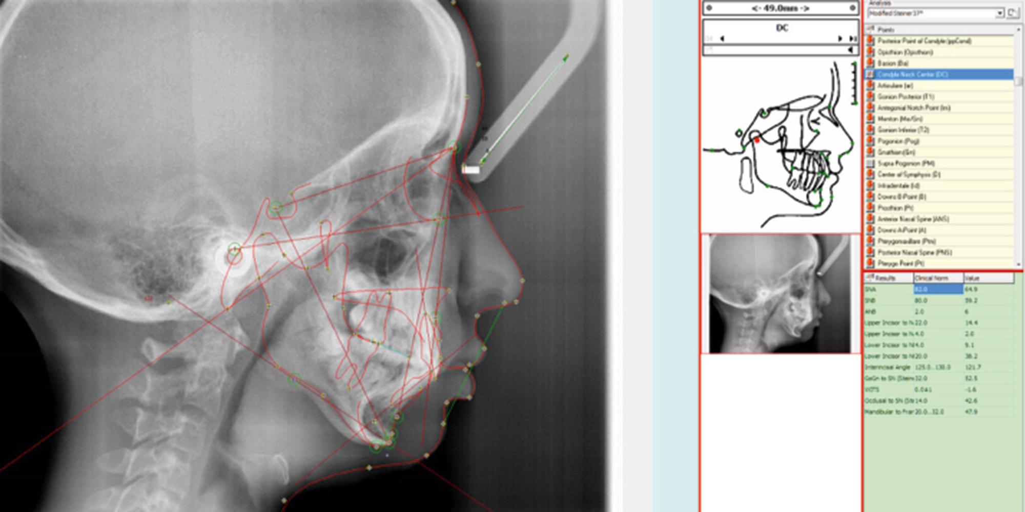 Fig. 21.12, Cephalometric tracings. Lateral cephalograms are used to plot specific anatomical landmarks that can further be analyzed using numerous software programs.