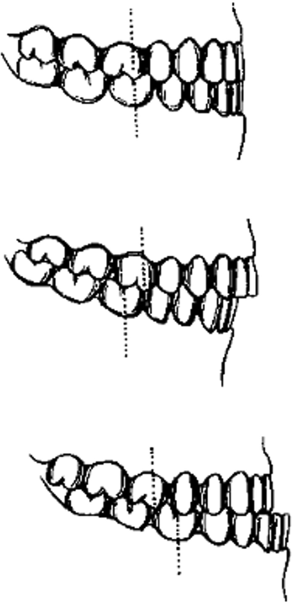 Fig. 21.2, Angle classification of occlusion. A, Class I normal occlusion. B, Class II, malocclusion. C, Class III, malocclusion.