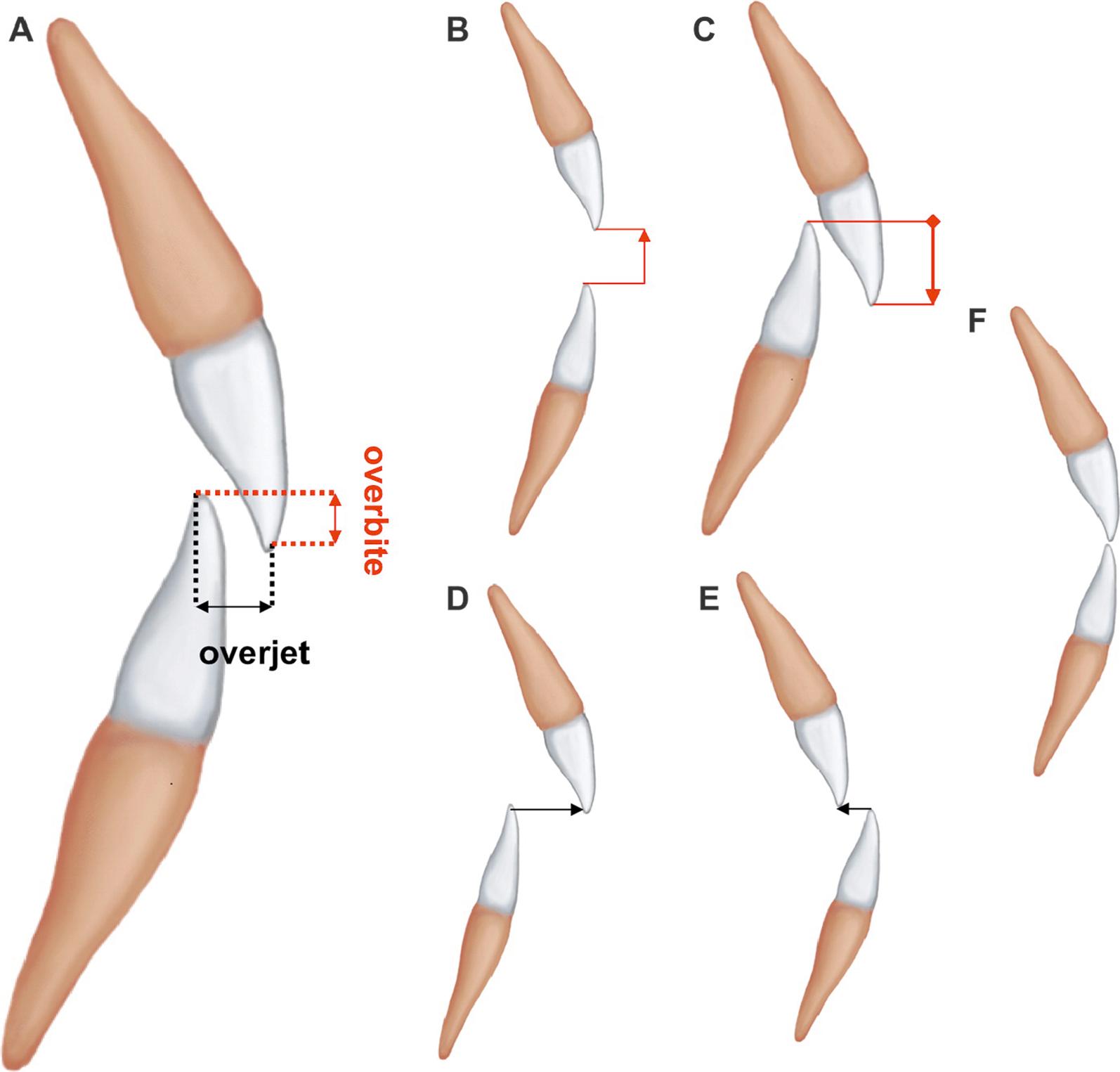 Fig. 21.3, Illustration of upper and lower incisor relationships. (A) Ideal overjet and overbite. (B) Open bite. (C) Deep bite. (D) Excessive overjet. (E) Reverse overjet or anterior crossbite or negative overjet. (F) Edge-to-edge relationship.