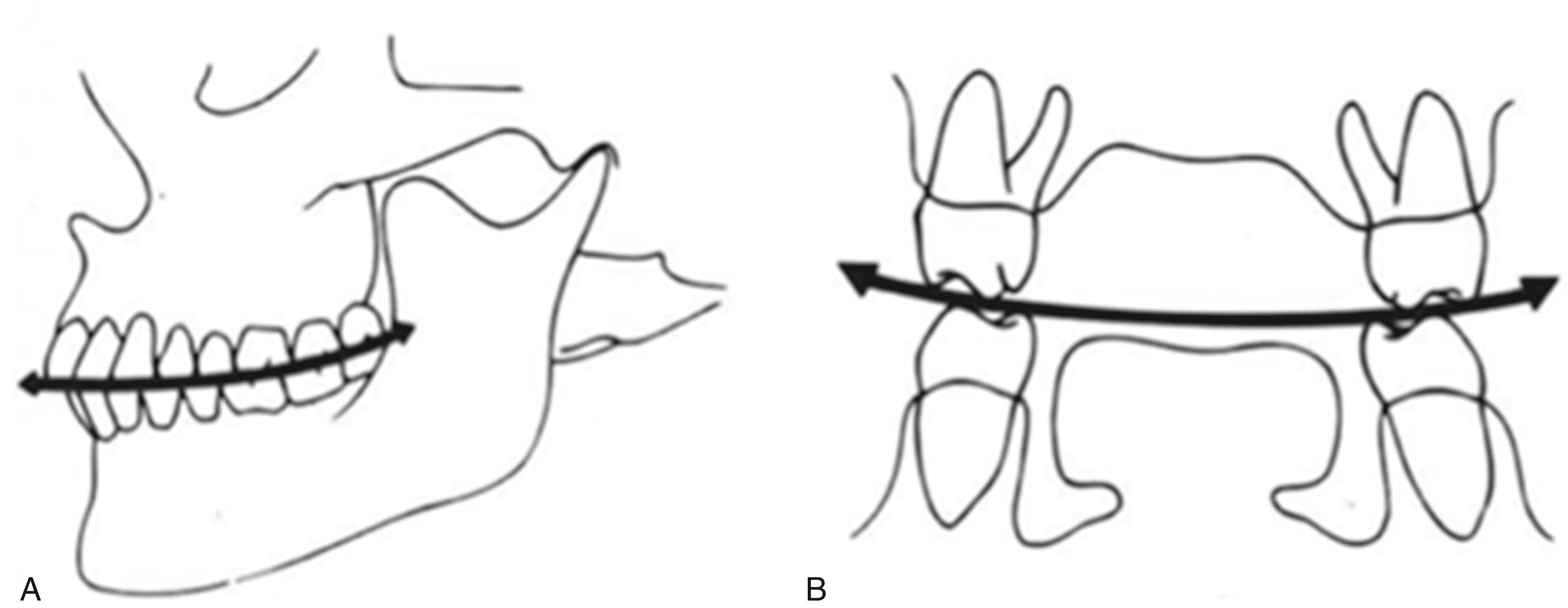 Fig. 21.4, Maxillomandibular relationships. (A) The curve of Spee, measured along the occlusal plane in the anteroposterior dimension. The curve of Wilson is shown in (B), which is a line drawn between the dentition in the frontal plane.