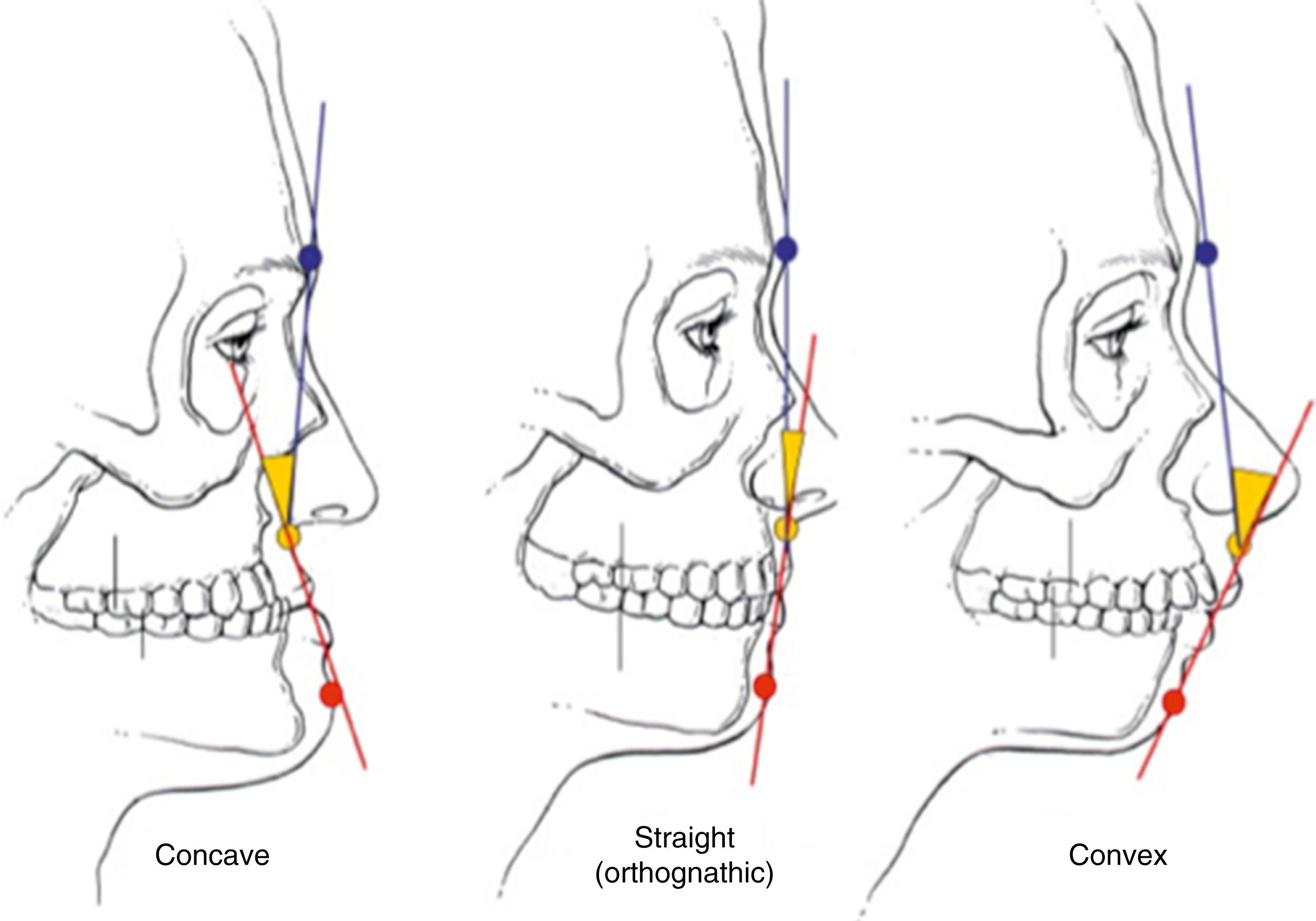 Fig. 21.7, Facial profile analysis. The facial profile can be classified as concave, convex, or straight.