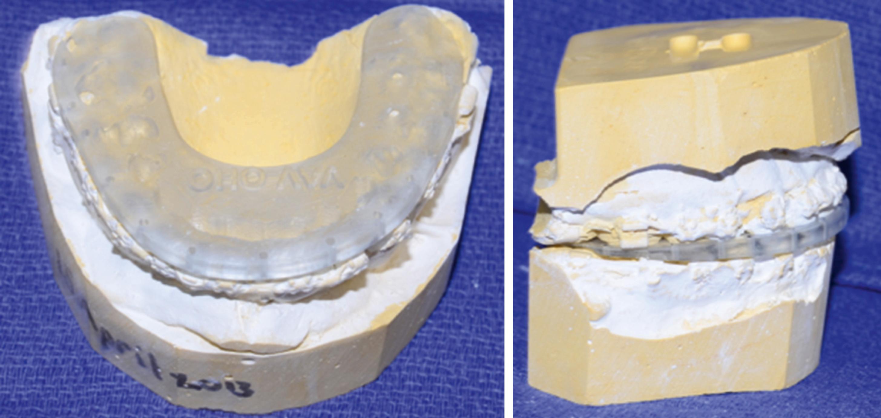 Fig. 21.9, Occlusal splints. These images demonstrate stone models that are used to create an acrylic occlusal surgical splint. The splints are fabricated for use intraoperatively when moving the maxilla and mandible into their new positions.