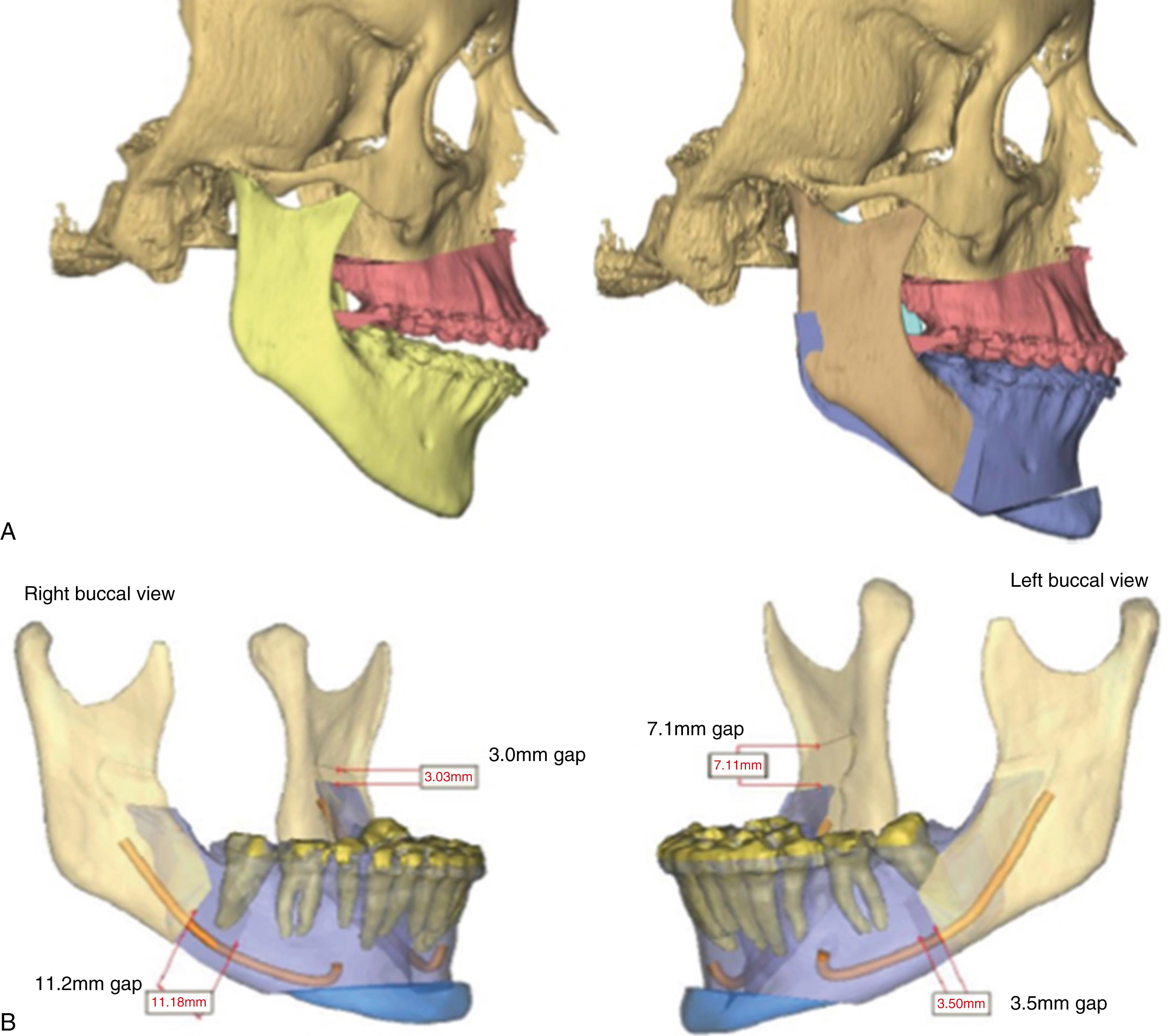 Fig. 21.10, Virtual surgical planning. Virtual surgical planning is performed after merging a computer rendering of the maxillary and mandibular dental aches with a computed tomography scan. Surgical movements can be simulated, showing precise measurements for each maneuver that is planned. Intermediate and final surgical splints are subsequently created from this session. (A) Shows movement of the maxilla via a Le Fort I procedure followed by bilateral sagittal split osteotomies to achieve counterclockwise rotation for closure of an anterior open bite. In a separate case, shown in (B), the surgeon can appreciate the amount of gapping and overlap that is created when performing yaw correction with bilateral sagittal split osteotomies.