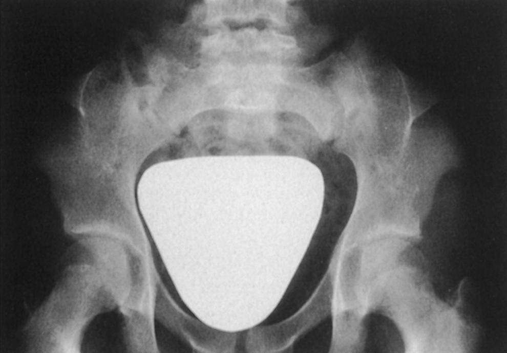 FIG. 37.12, Anteroposterior pelvic radiograph of a 14-year-old girl with nail-patella syndrome. Bilateral iliac horns are seen protruding from the iliac wings.