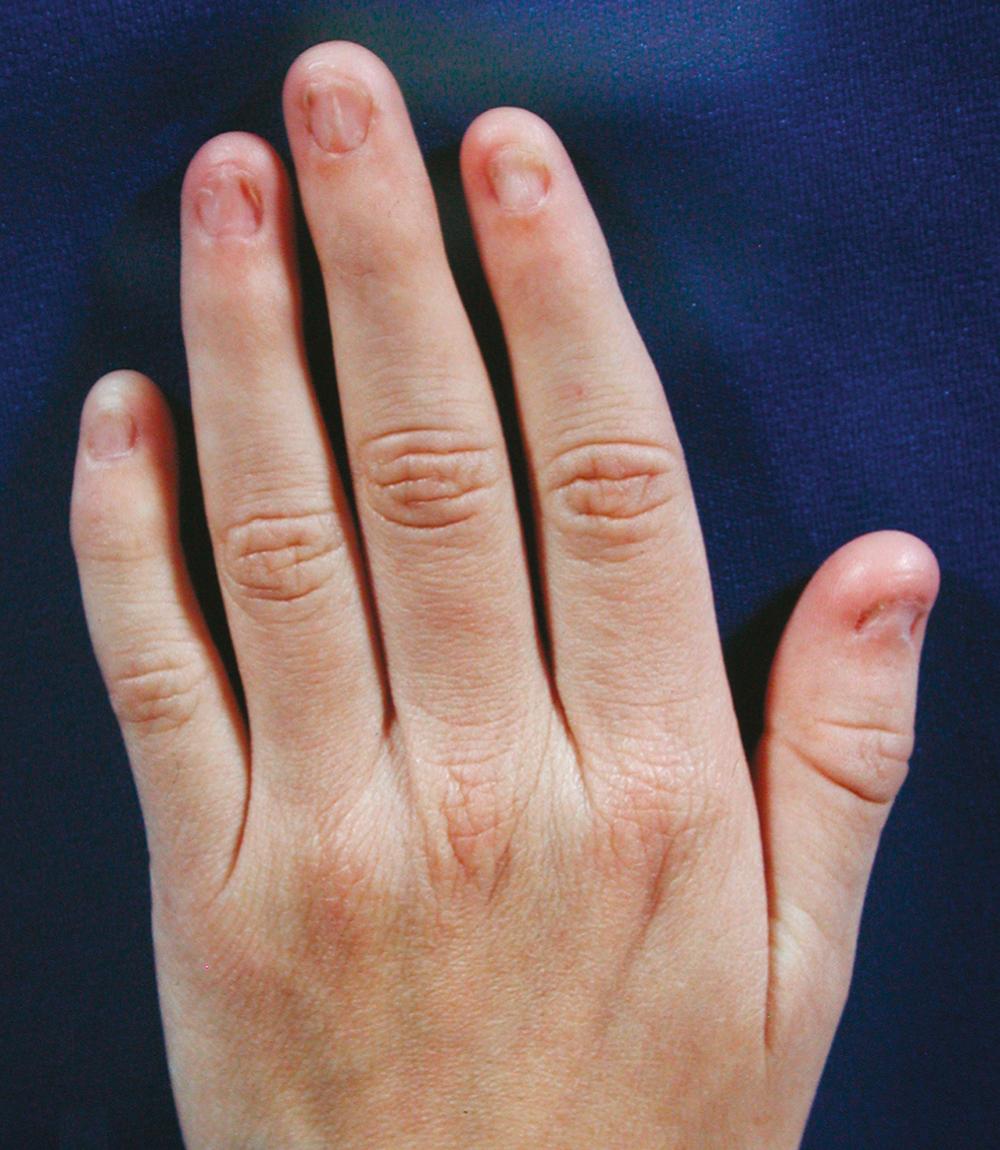 FIG. 37.13, Dystrophic nails in a 10-year-old girl with nail-patella syndrome. The ulnar digits are less affected than the thumb.