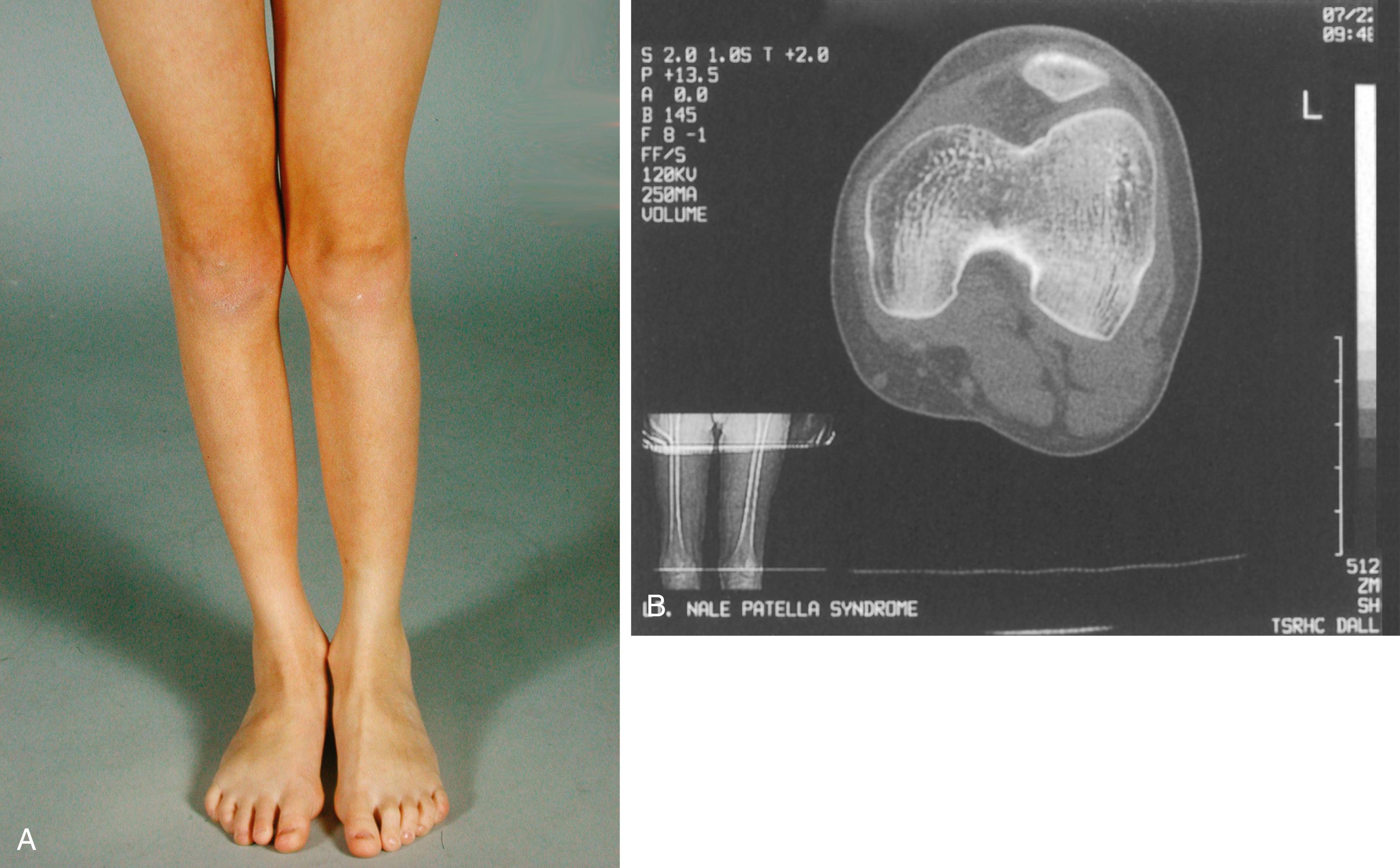 FIG. 37.15, (A) Clinical appearance of the lower extremities of a 10-year-old girl with nail-patella syndrome and patellofemoral instability. (B) Computed tomography scan of the patellofemoral joint reveals hypoplasia of the patella and a shallow femoral groove.