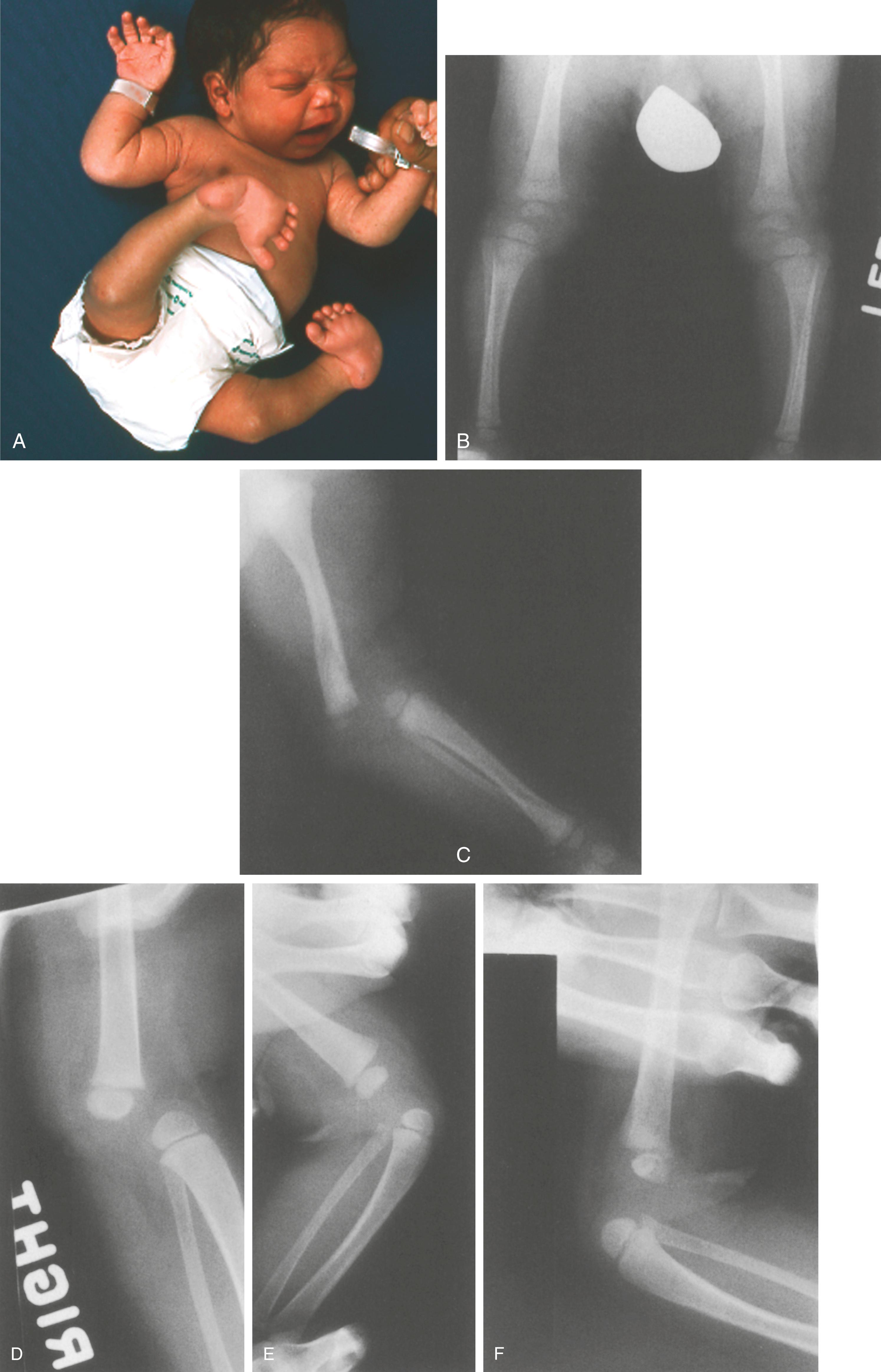 FIG. 37.17, Larsen syndrome. (A) Newborn infant with obvious dislocated knees and clubfeet. (B and C) Radiographs show grade 3 complete dislocation of the knee. (D) Grade 3 dislocation of the knee in another patient. (E and F) Incomplete reduction following cast correction. Both knees subsequently underwent open reduction.