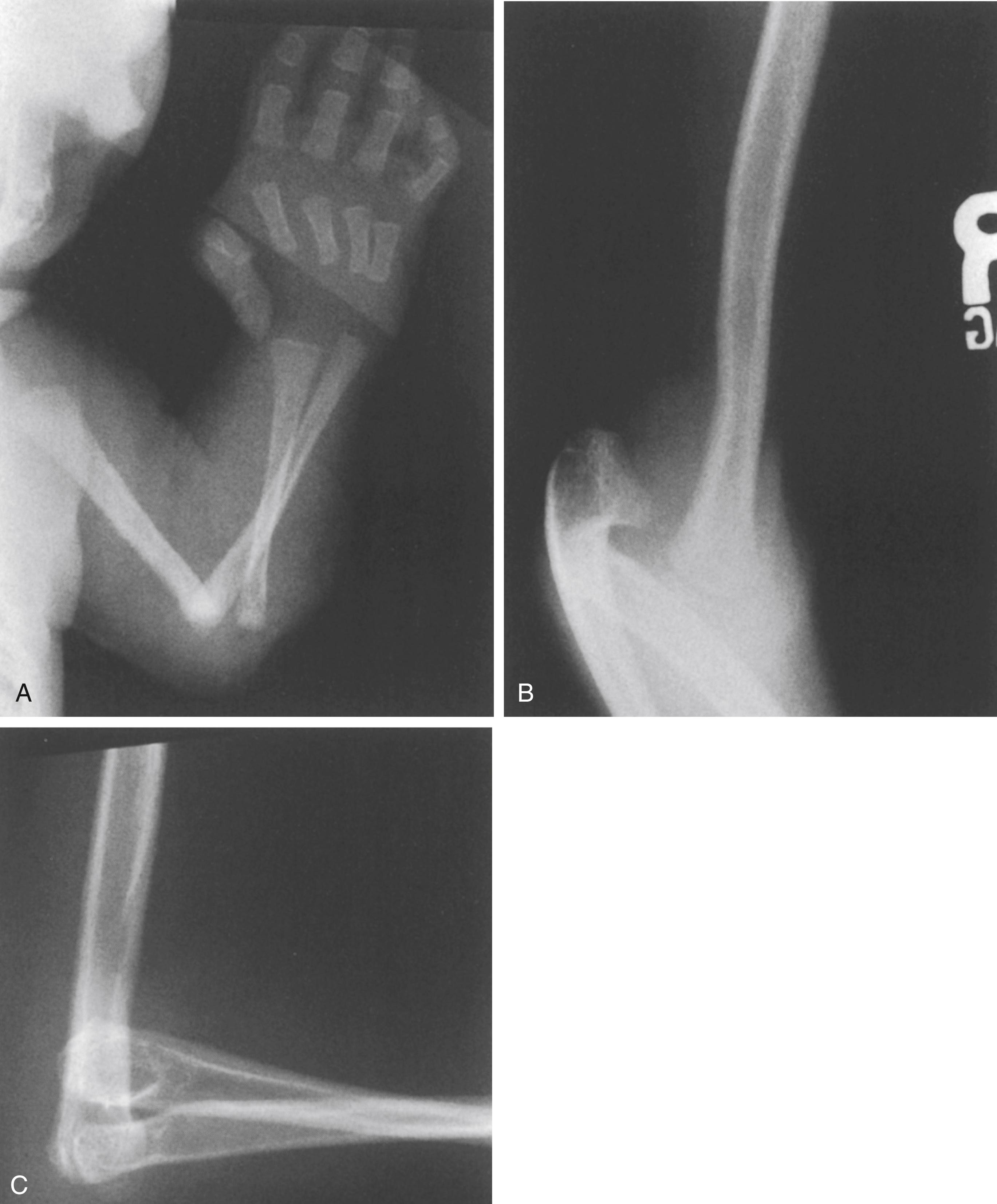 FIG. 37.18, Larsen syndrome. (A) Right elbow in a newborn. Note the complete radiocapitellar and humeroulnar dislocation. The thumb is also dislocated at the metacarpophalangeal joint. (B and C) Radiographic appearance at age 6 years. Marked webbing and a 90-degree flexion contracture accompany the untreated deformity.