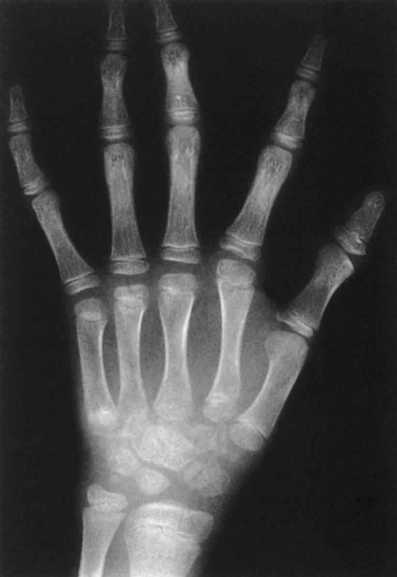 FIG. 37.20, Extra carpal bone ossific nuclei in a 9-year-old with Larsen syndrome.