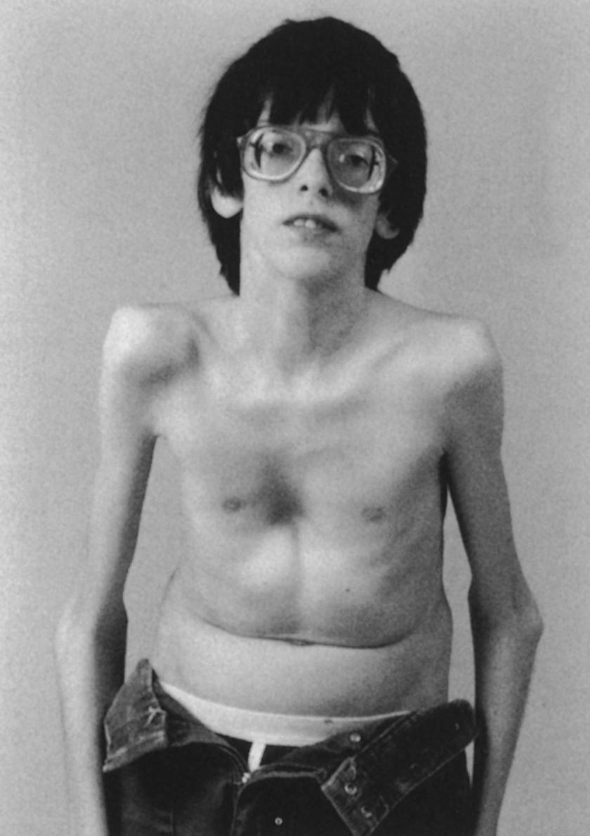 FIG. 37.2, Clinical appearance of a patient with Marfan syndrome. Note the extreme myopia (represented by thick corrective lenses), severe pectus excavatum, long limbs, and arachnodactyly. The patient also has scoliosis and severe planovalgus feet. This appearance is typical of patients with florid manifestations of the syndrome.