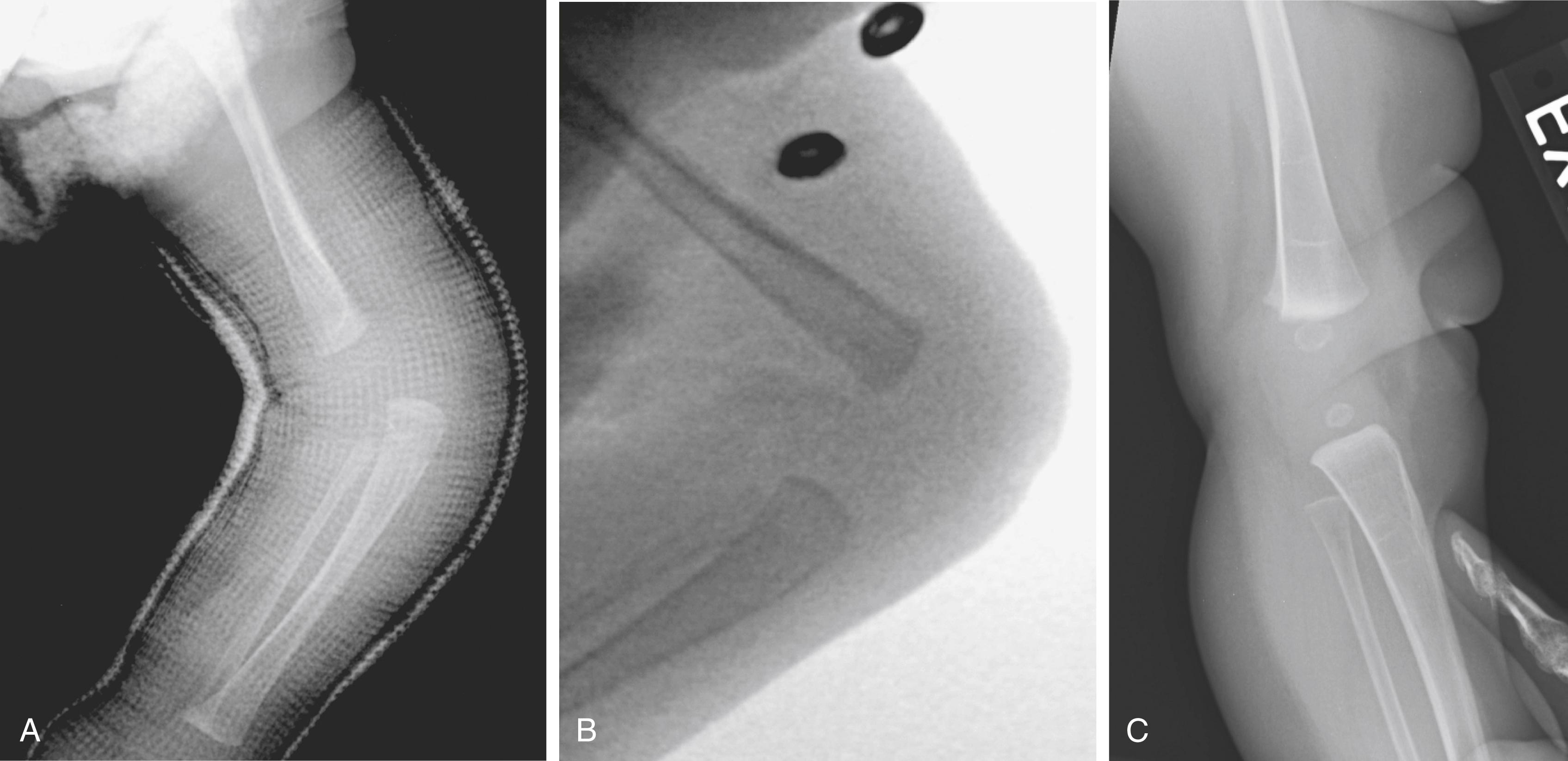 FIG. 37.21, (A) Left knee in maximum flexion after manipulation and casting in a 1-month-old boy with Larsen syndrome. (B) Two months later, following botulinum toxin (Botox) injection of the quadriceps and daily physical therapy. (C) At age 11 months, the range of motion is −10 to 110 degrees flexion.