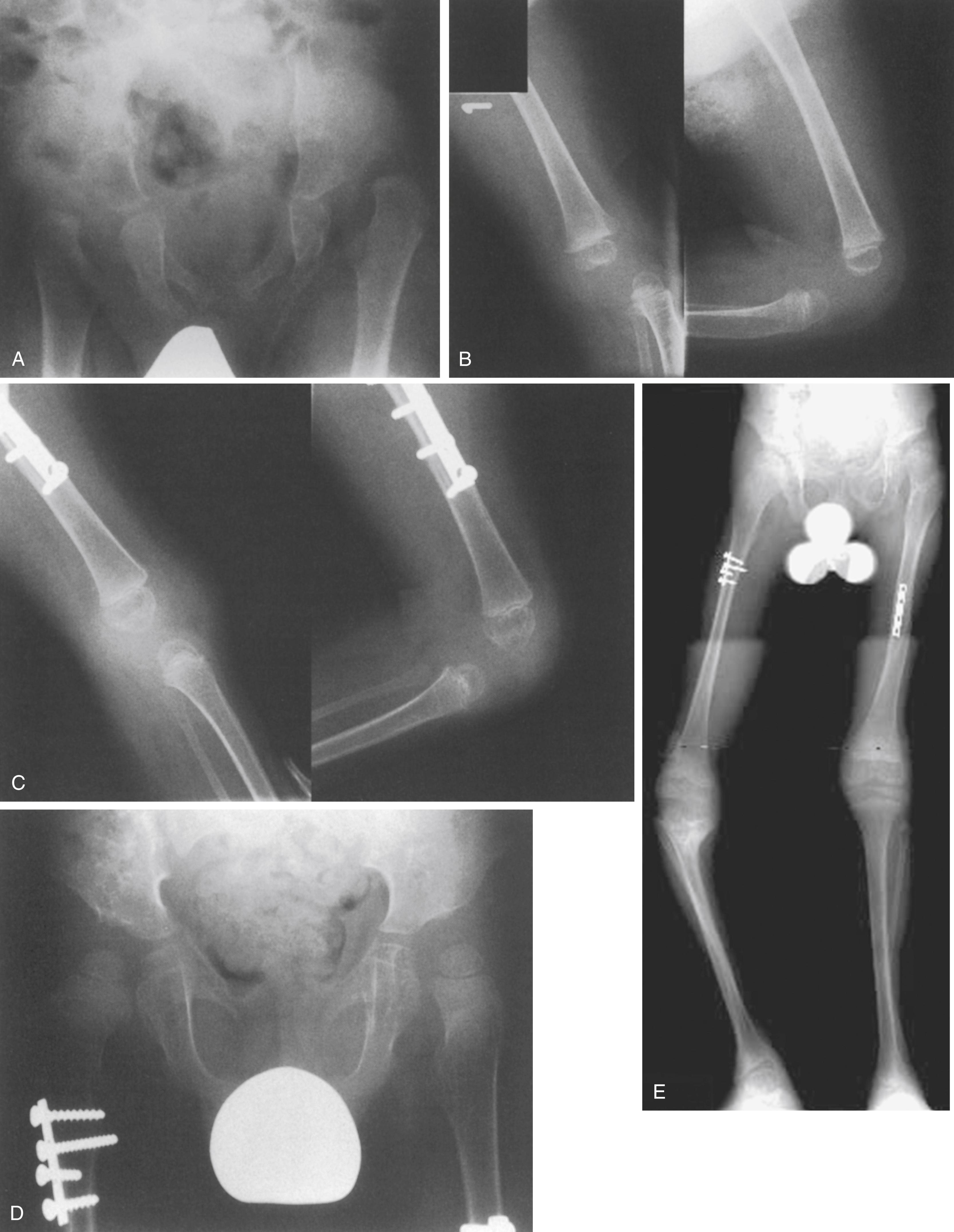 FIG. 37.24, Simultaneous reduction of congenital hip and knee dislocations in Larsen syndrome. (A) Radiograph obtained after age 1 year showing bilateral teratologic hip dislocation. (B) Unstable left knee in the same patient following closed reduction and casting. (C) Appearance after open reduction of the left hip and knee with diaphyseal shortening and anterior cruciate ligament reconstruction using the iliotibial band. The right hip and knee had undergone similar treatment 3 months earlier. (D) Hip reduction 2 years postoperatively. (E) Appearance 10 years postoperatively. Both knees were clinically stable and did not require orthoses. Despite identical cruciate ligament reconstruction and posteromedial capsular imbrication in both knees, the right one suffered proximal tibial growth arrest. Eventually, the alignment was corrected by opening wedge valgus osteotomy.